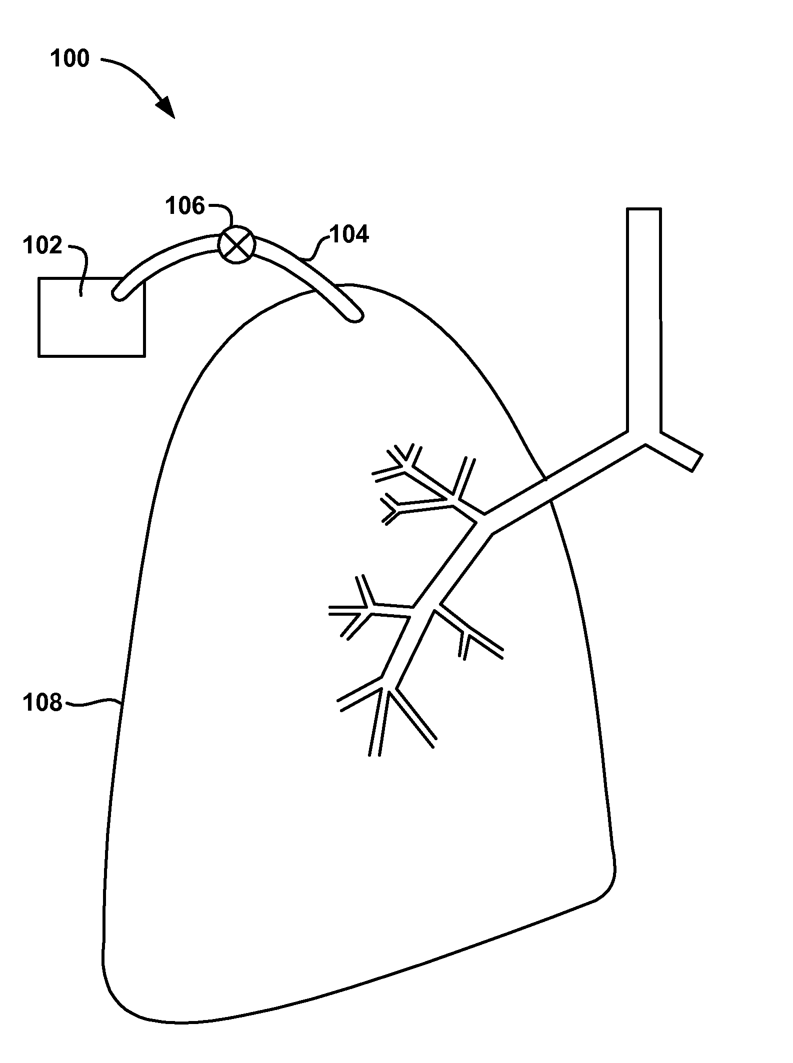 Methods and devices to create a chemically and/or mechanically localized pleurodesis
