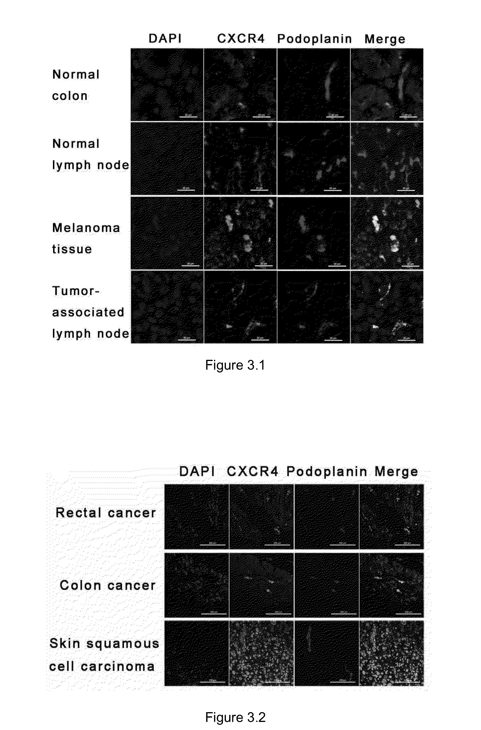 Method and medicament for inhibiting lymphangiogenesis