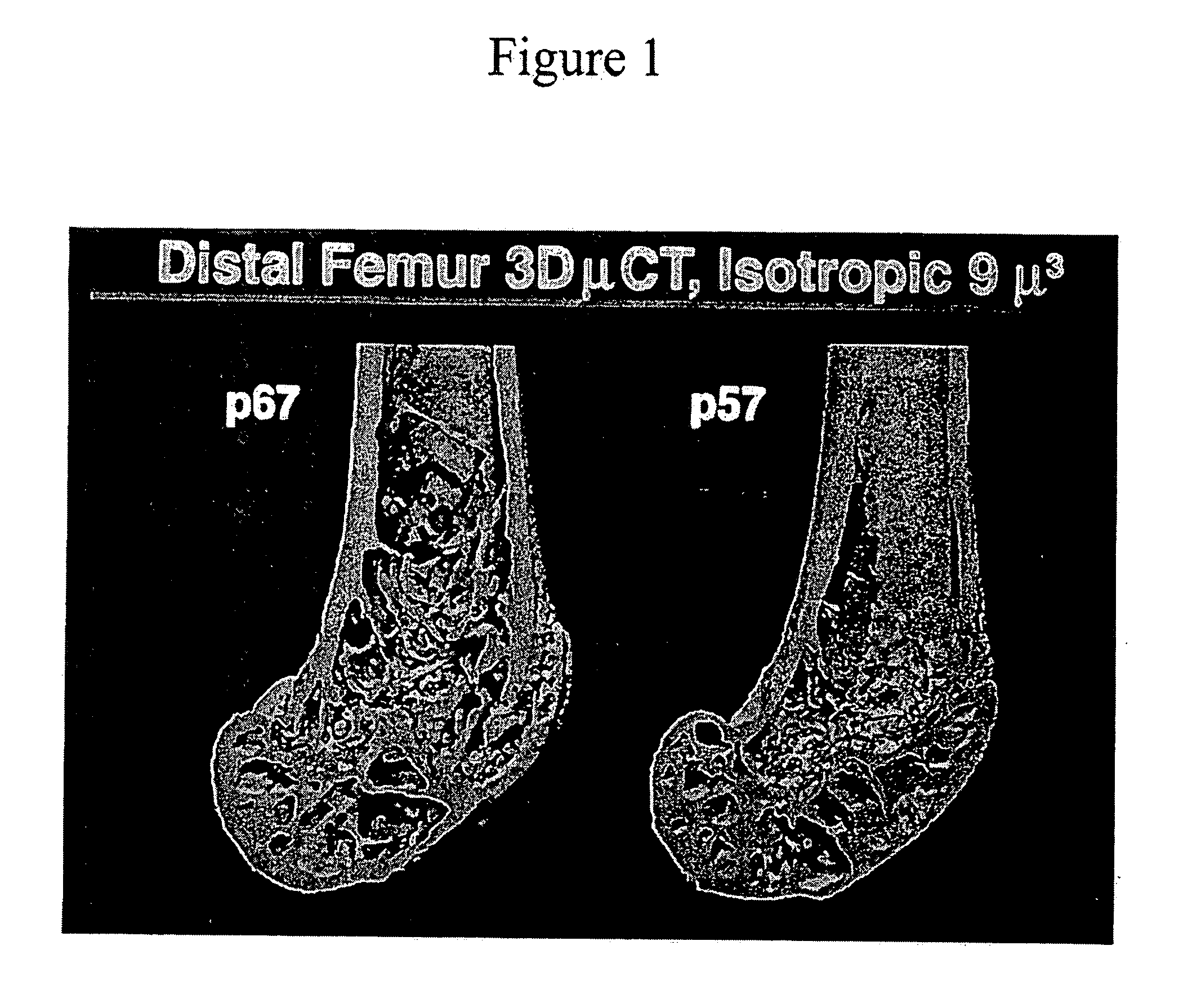 Pthrp-based prediction and diagnosis of bone disease