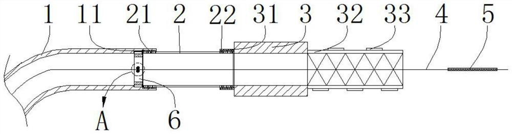 Conformal particle stent and delivery catheter set based on portal vein