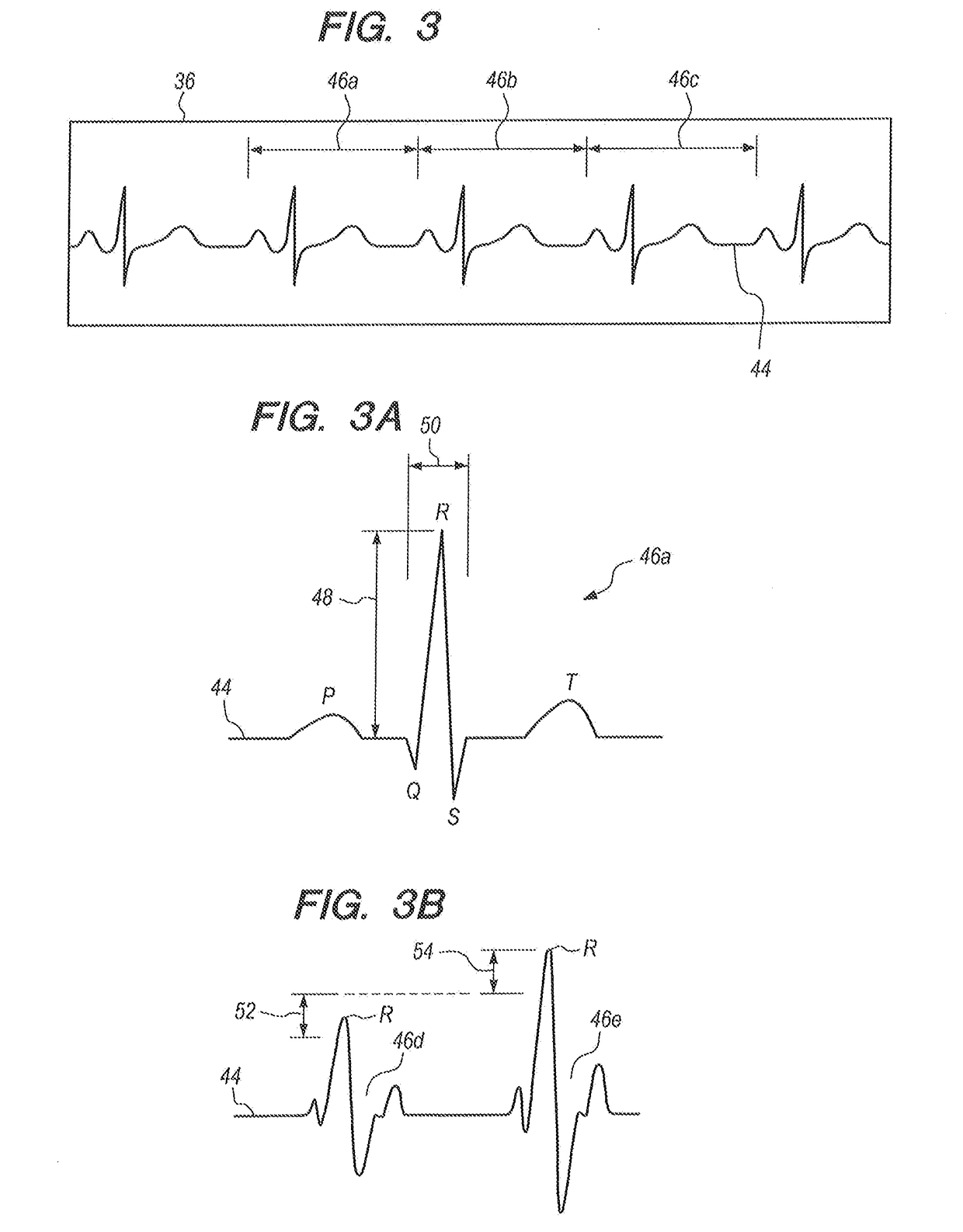 System for monitoring and evaluating cardiac anomalies