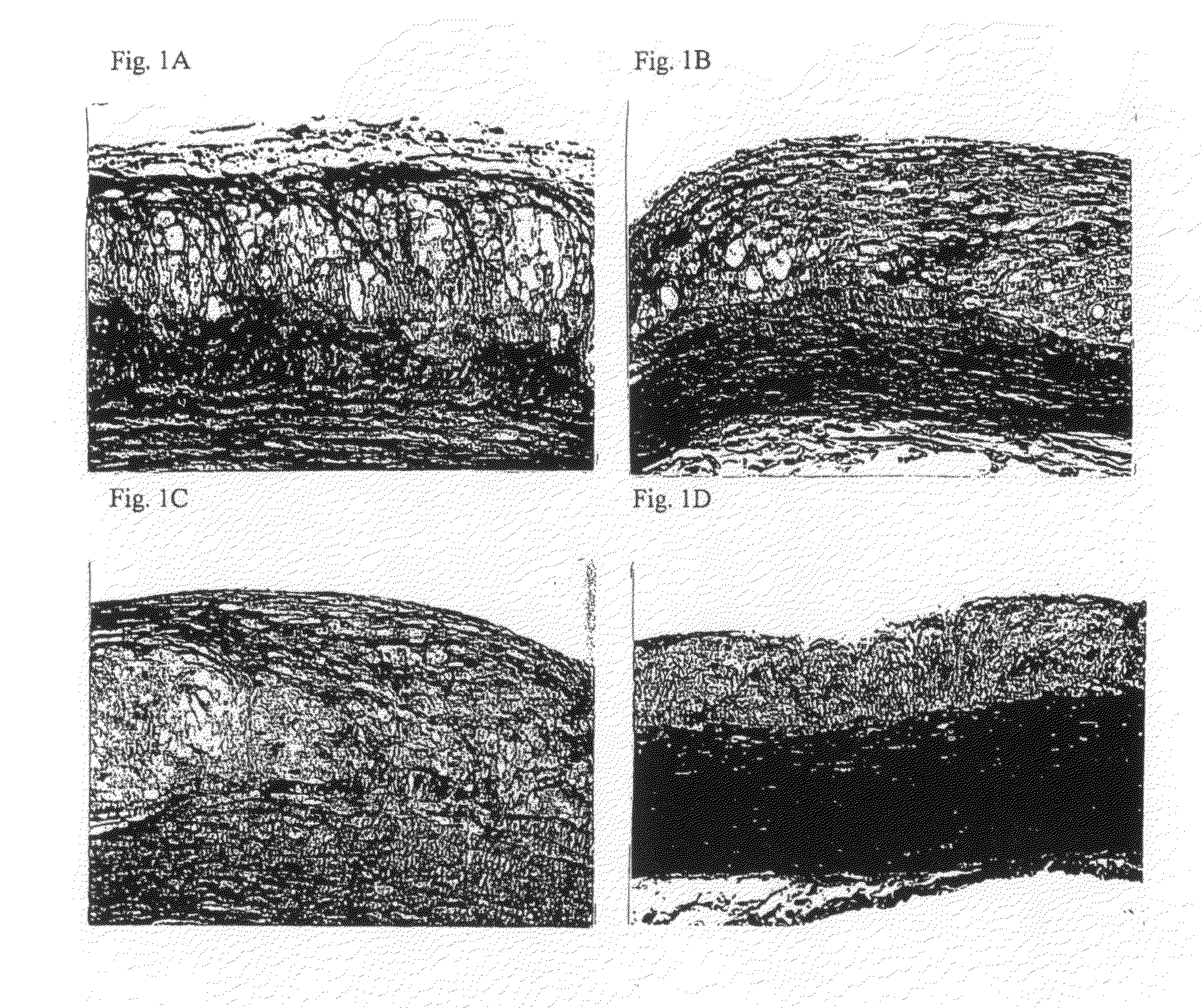 Method for reduction, stabilization and prevention of rupture of lipid rich plaque