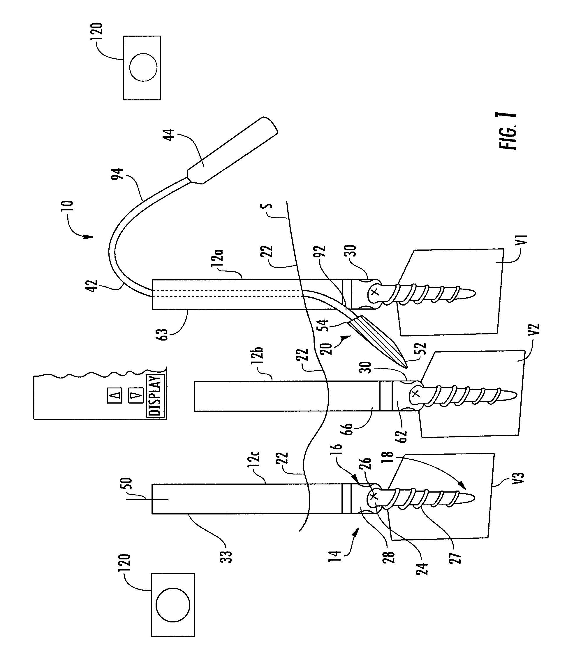Method and apparatus for facilitating navigation of an implant