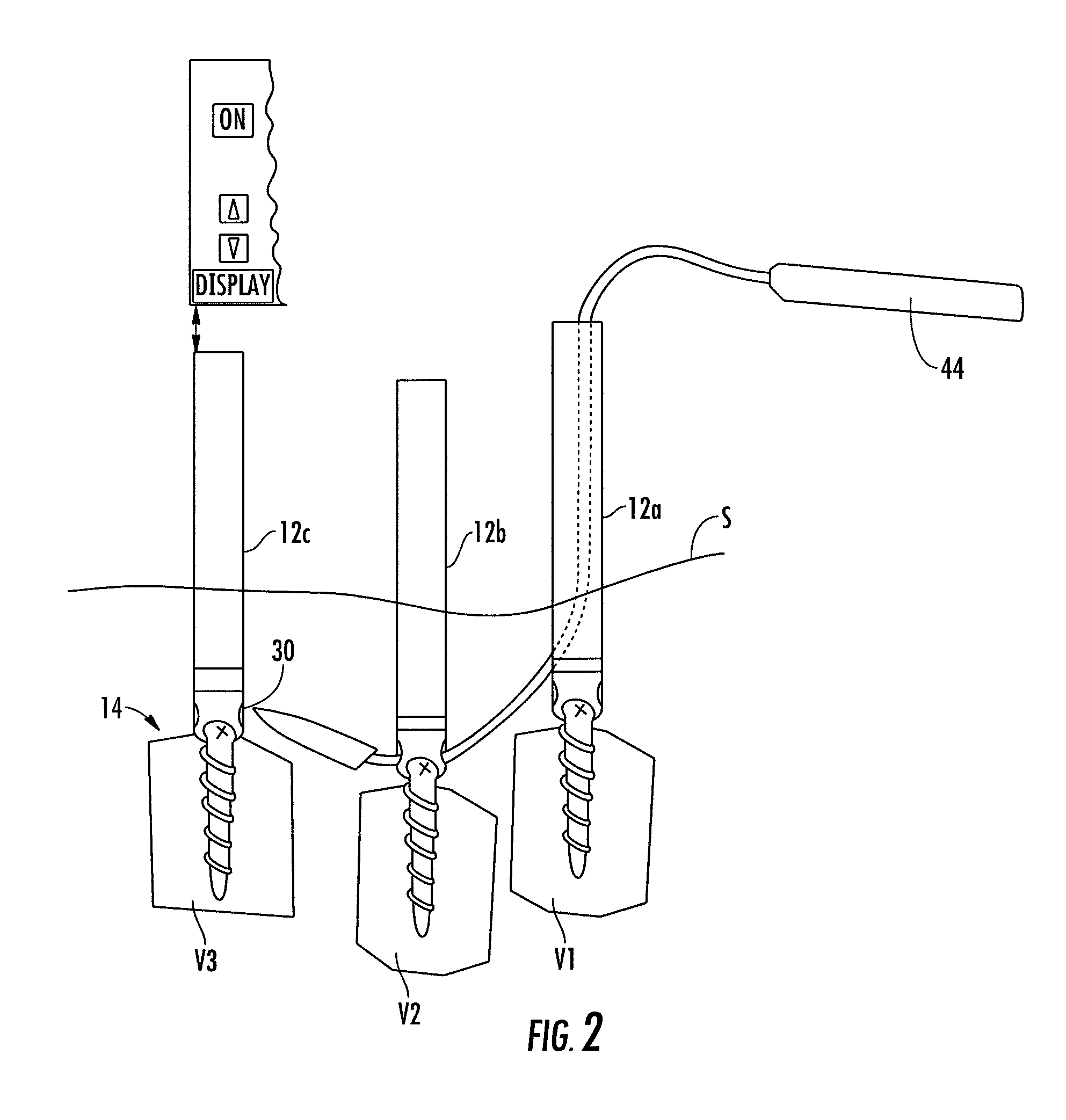 Method and apparatus for facilitating navigation of an implant