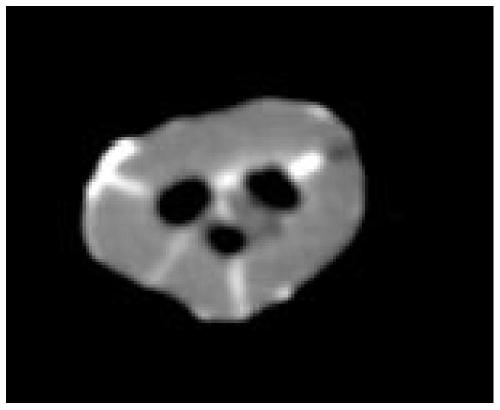 A Method for Detecting Fractures and Cracks of Cracked Teeth Using Image Intensifier and Cone Beam CT Imaging Technology