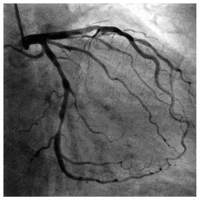 A kind of image fusion method and system of CT coronary image and xa angiography image