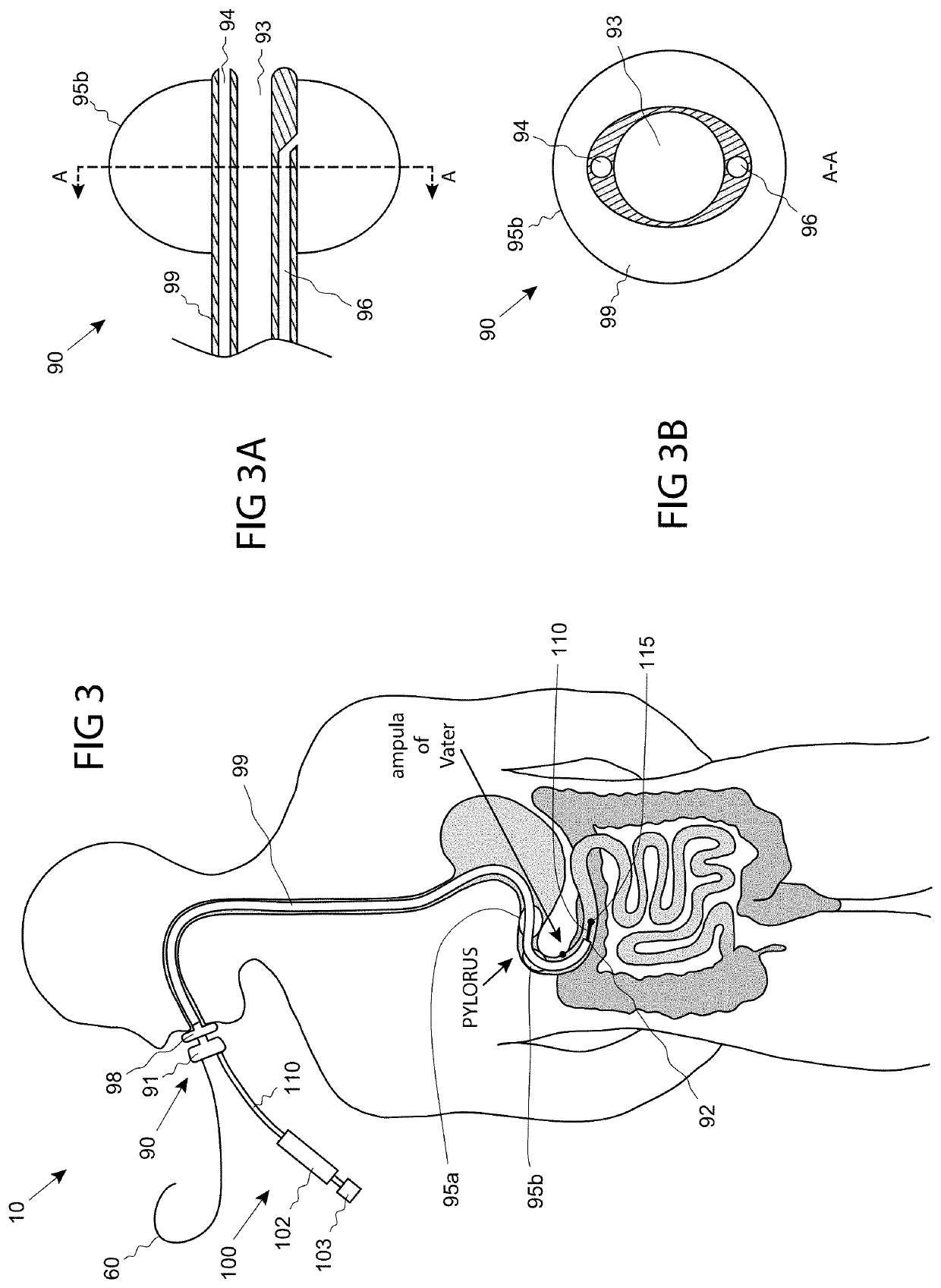 Systems, devices, and methods for performing medical procedures in the intestine