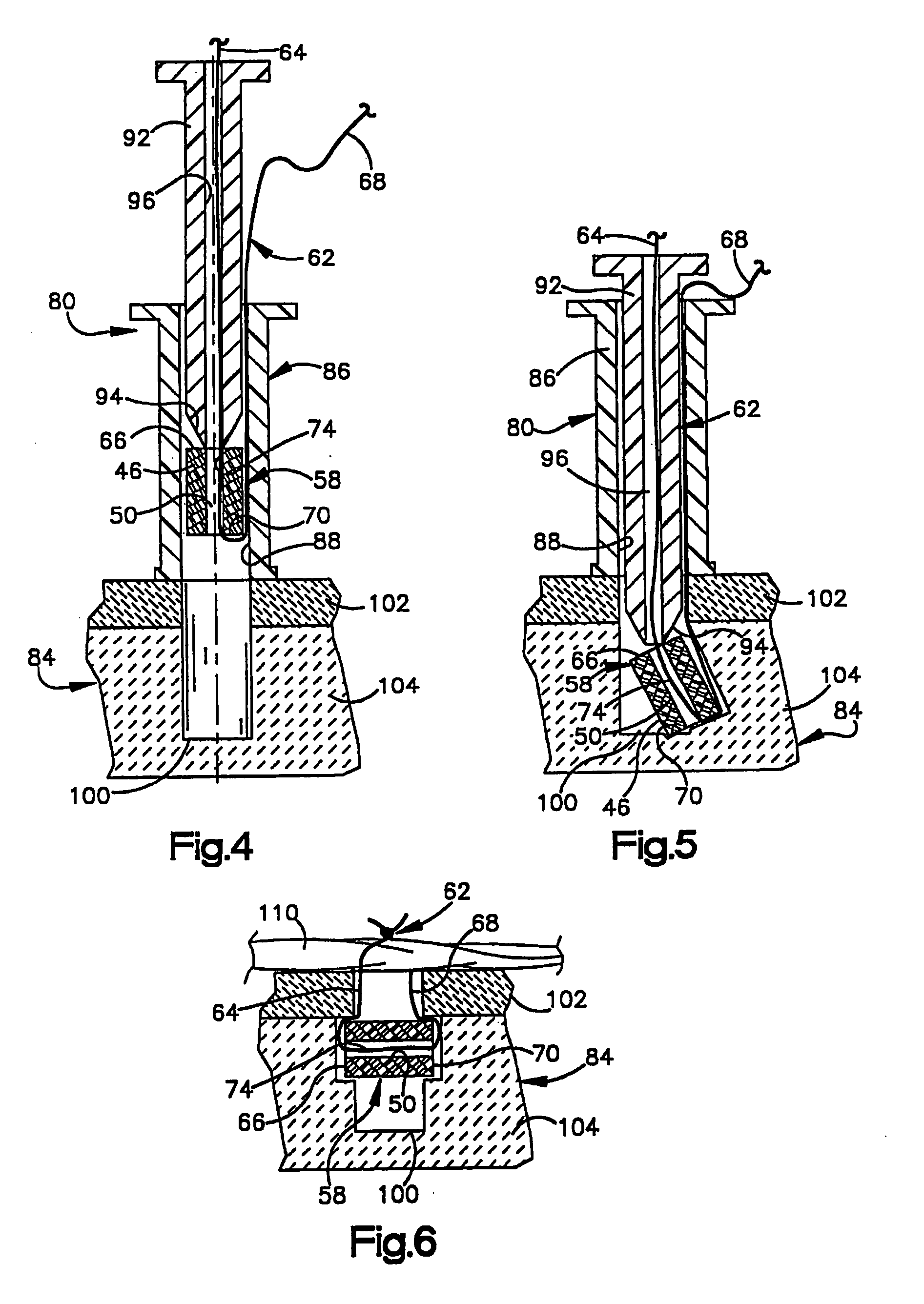 Suture anchor