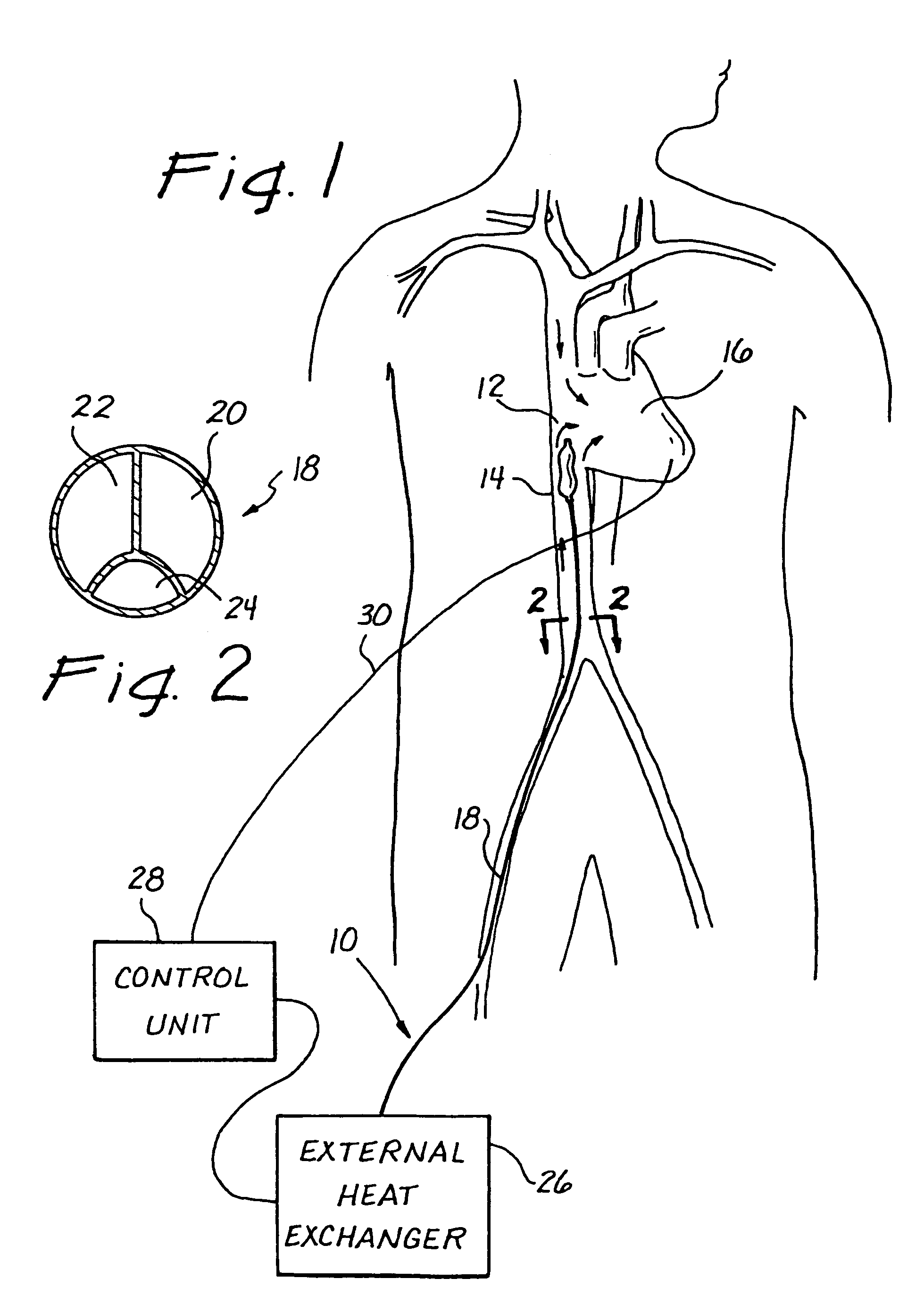 Use of intravascular hypothermia during angioplasty procedures