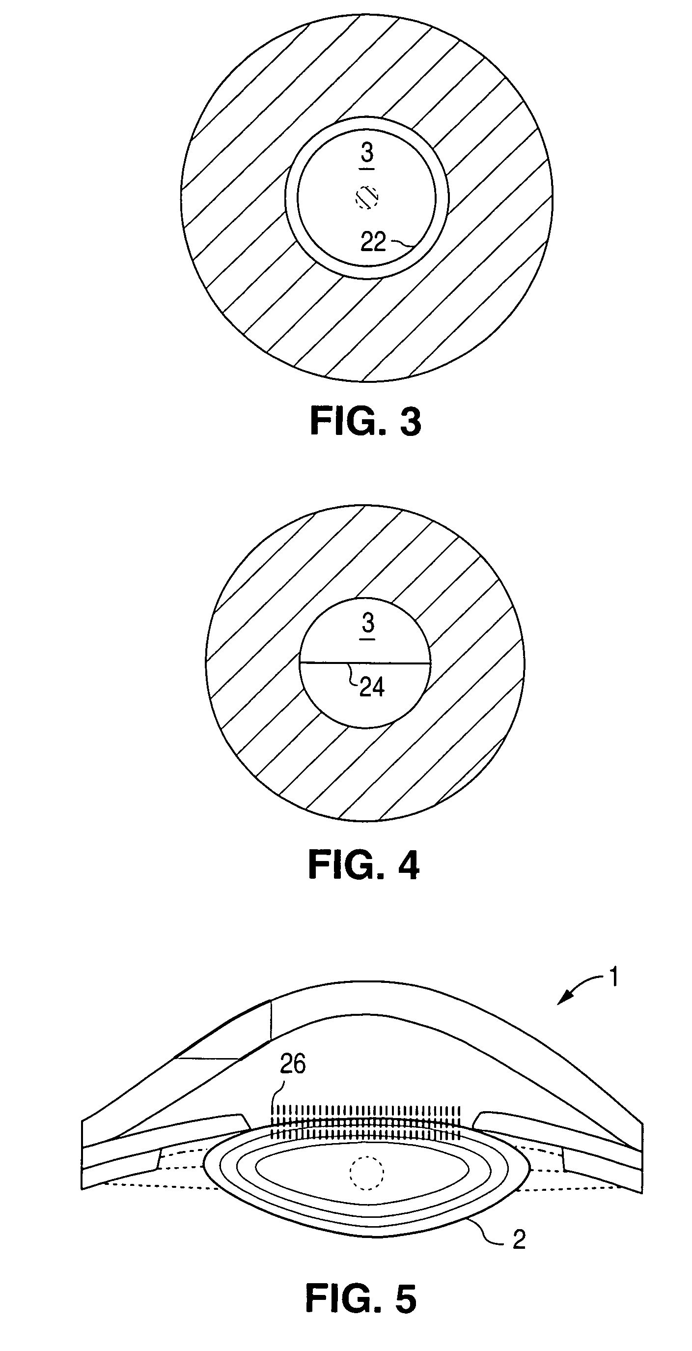 Method and apparatus for patterned plasma-mediated laser trephination of the lens capsule and three dimensional phaco-segmentation