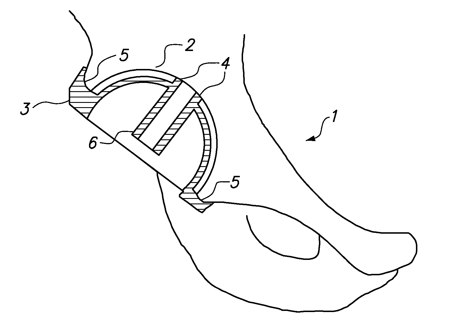 Device and method for achieving accurate positioning of acetabular cup during total hip replacement