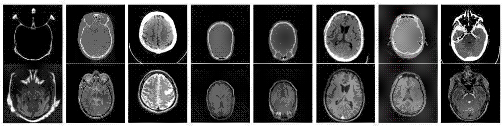 Brain CT/MR (Computed Tomography/ Magnetic Resonance) image fusion method for improved coupled dictionary learning on the basis of sparse representation