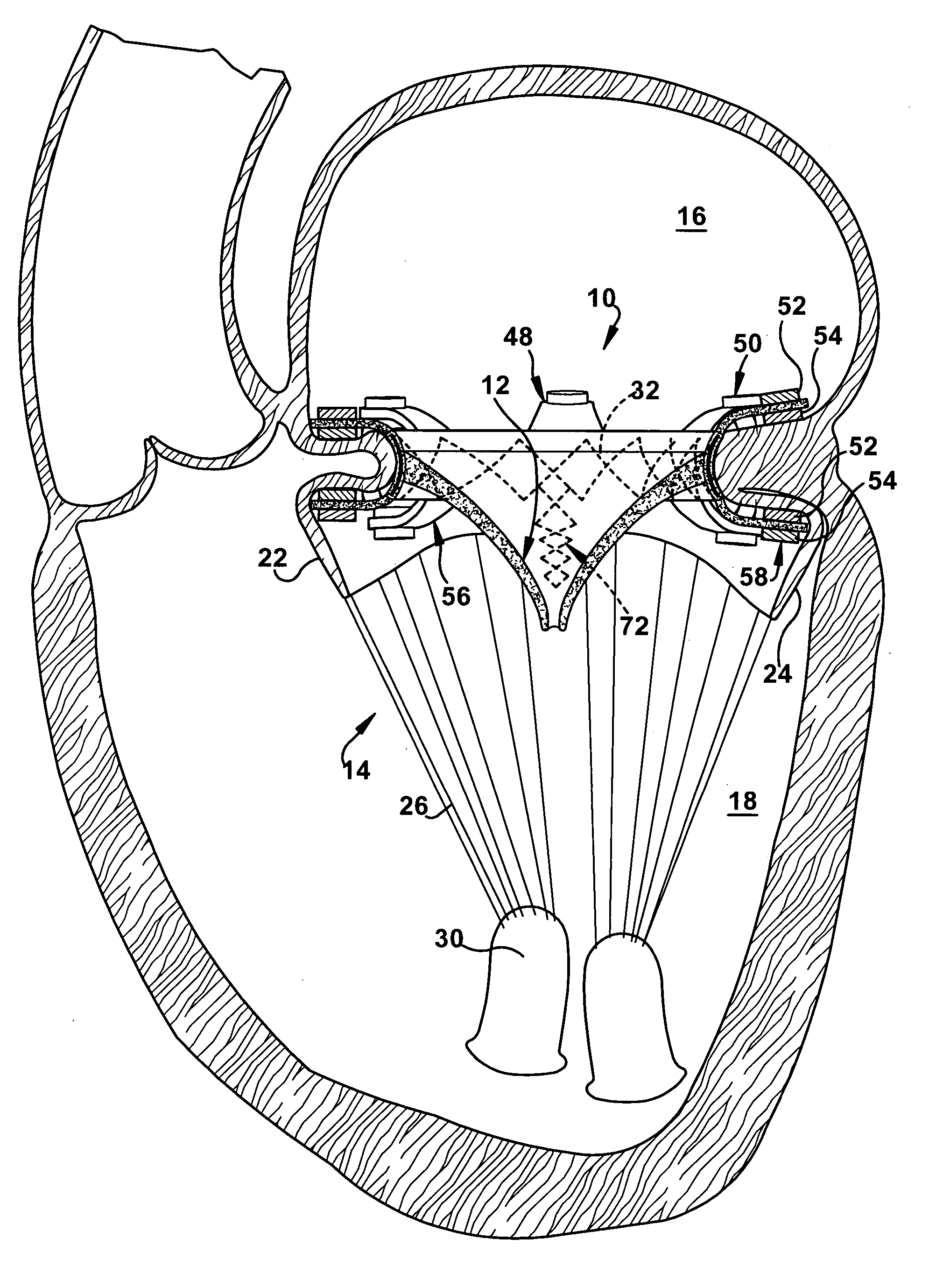 Apparatus and method for replacing a cardiac valve