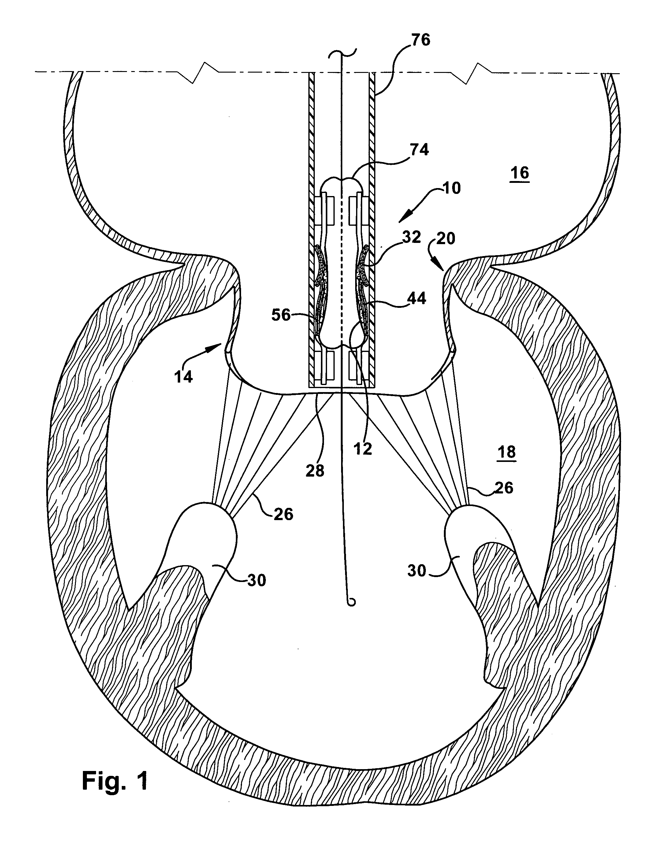 Apparatus and method for replacing a cardiac valve