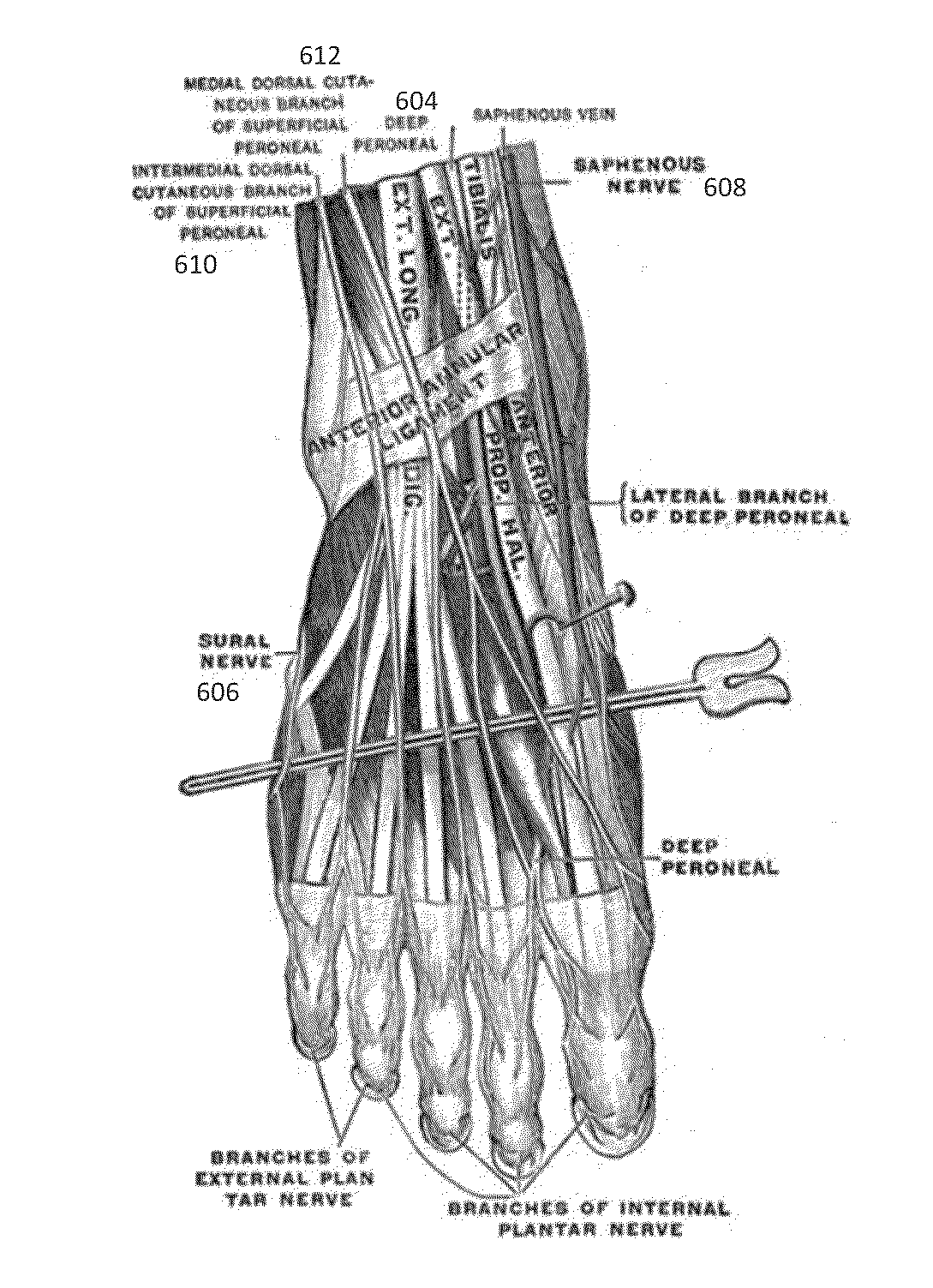 Methods, Systems, and Devices for Treating Neuromas, Fibromas, Nerve Entrapment, and/or Pain Associated Therewith