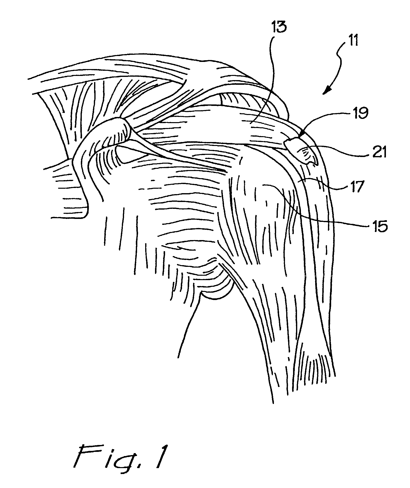 Linear suturing apparatus and methods