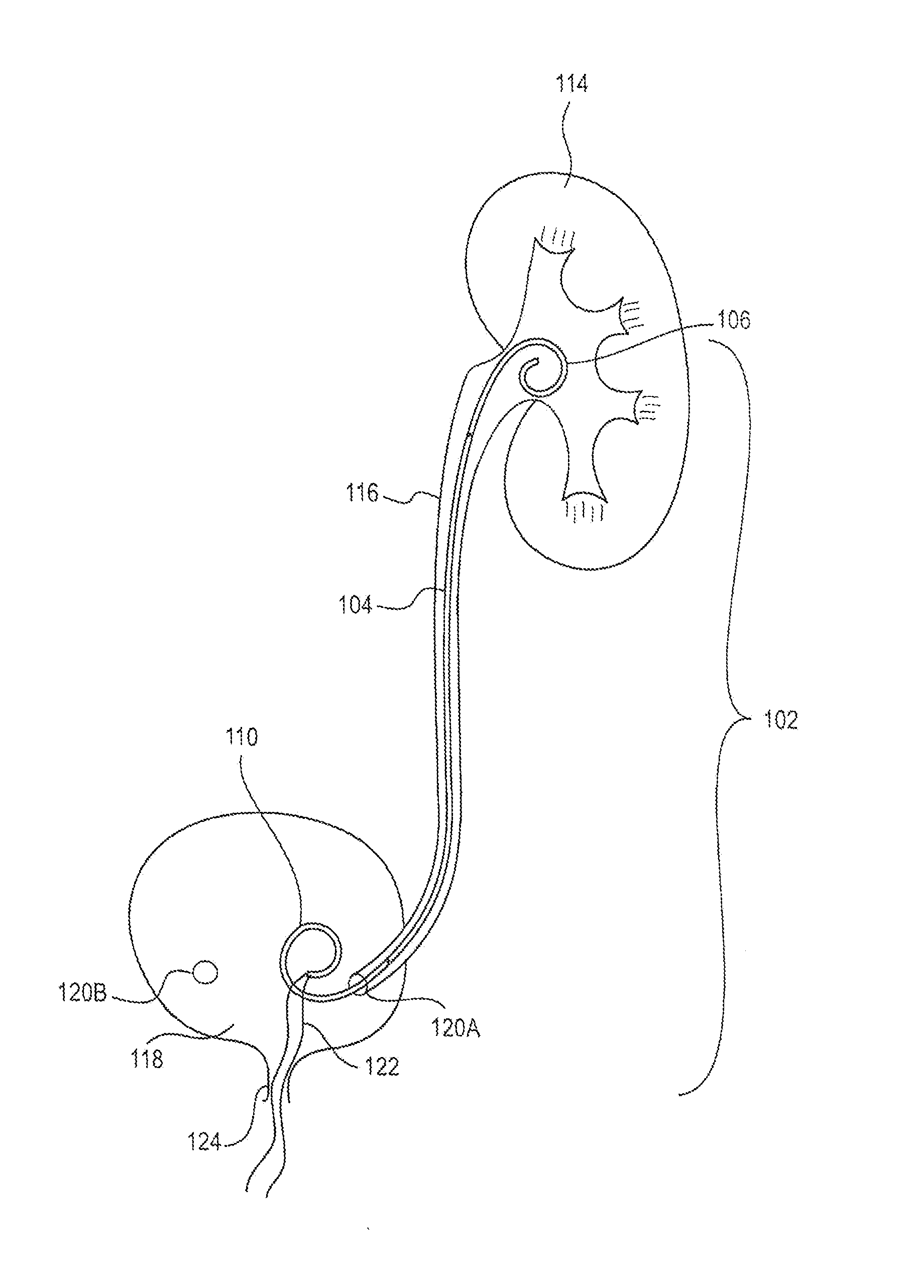 Stents and methods of use thereof