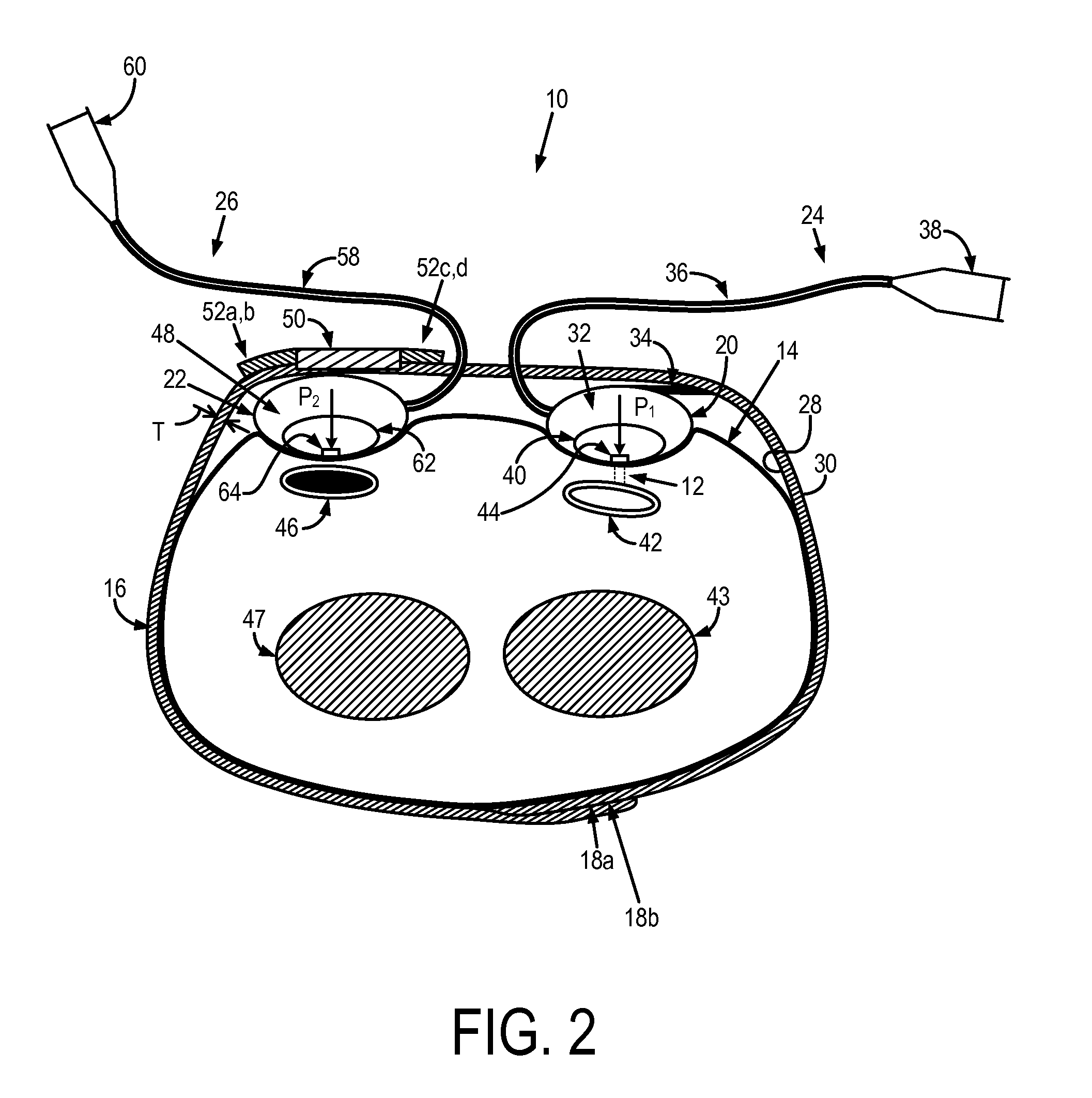 System and method for achieving patent hemostasis in arteries