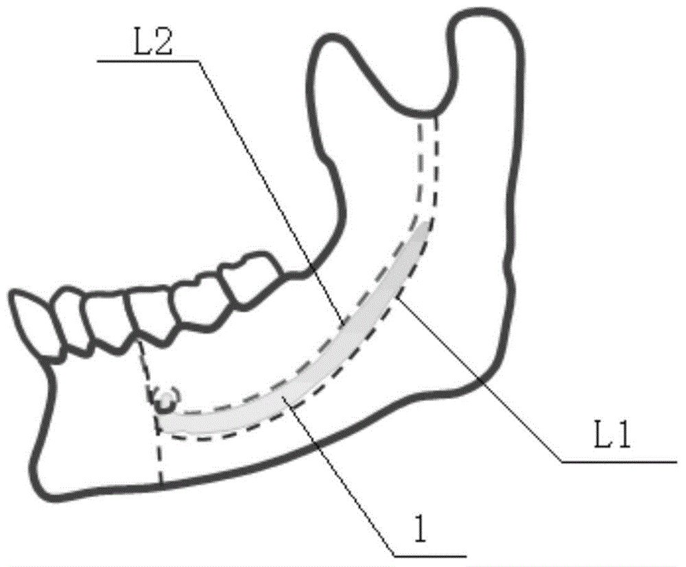 Nerve protection guide plate for mandible osteotomy