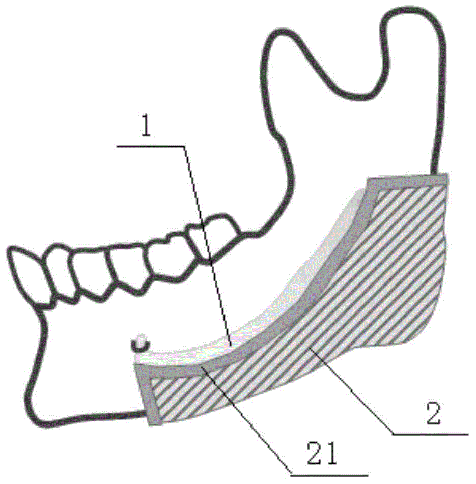 Nerve protection guide plate for mandible osteotomy