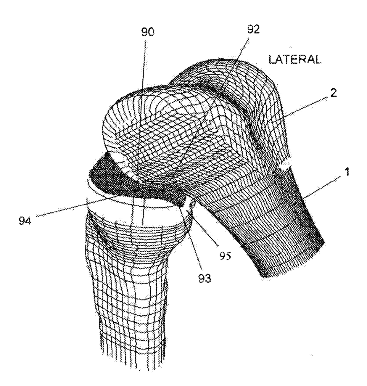 Total knee replacement implant based on normal anatomy and kinematics