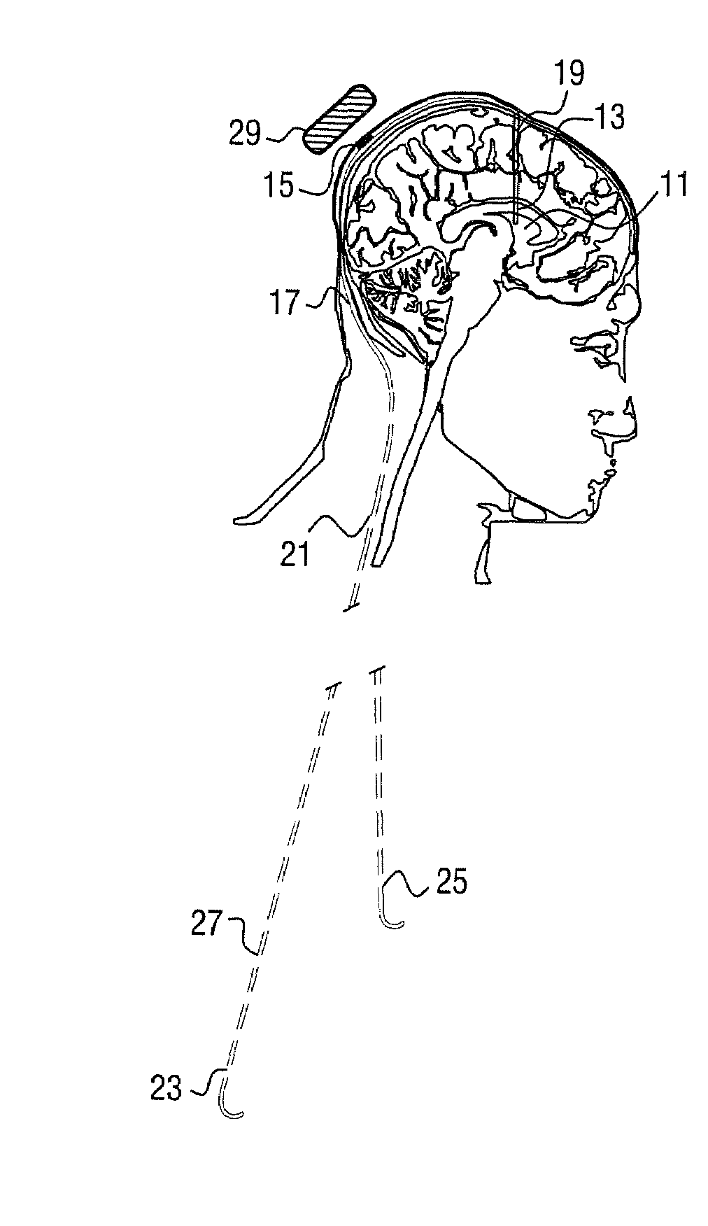 Electroactive polymer actuated cerebrospinal fluid shunt