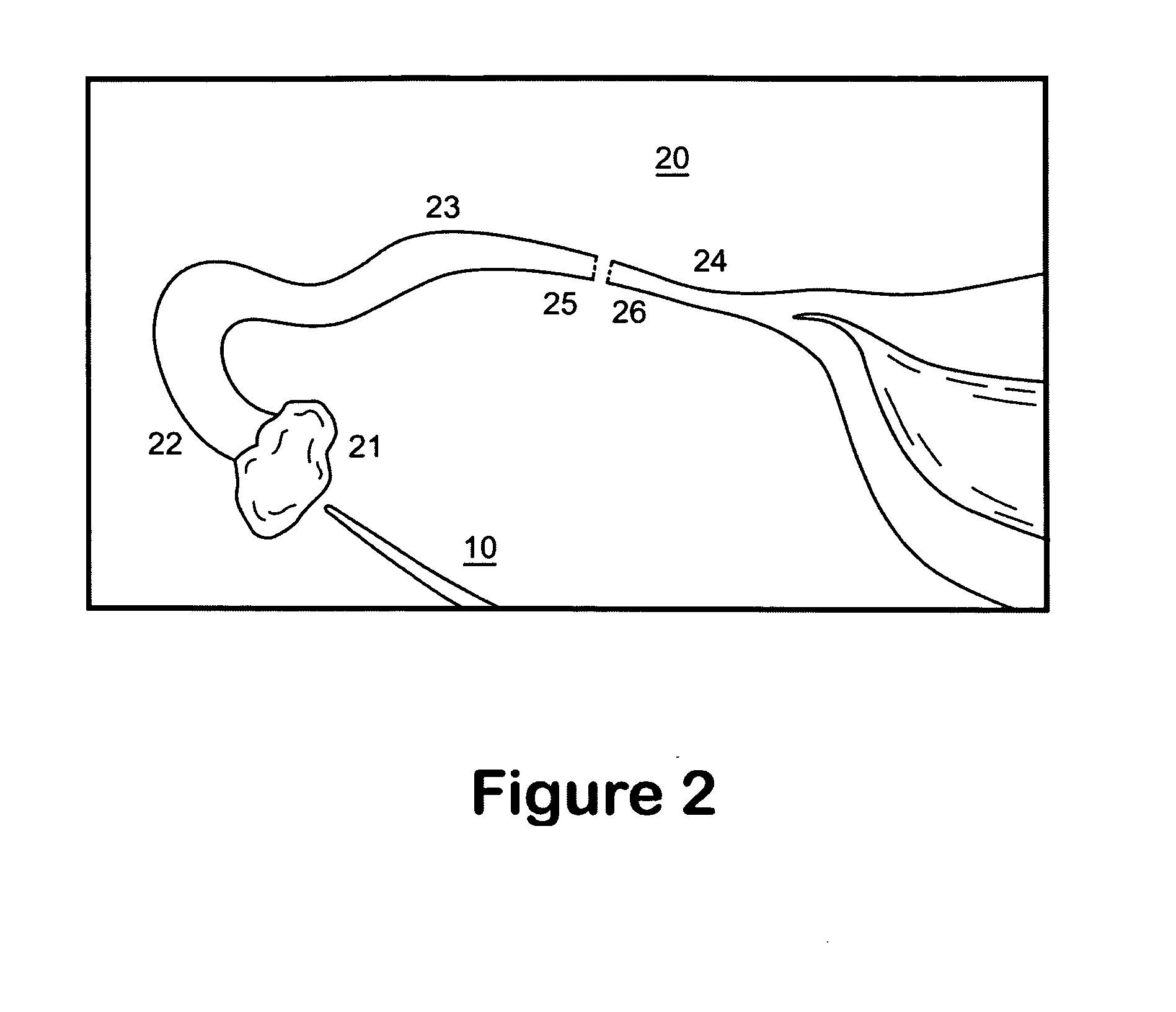 Fallopian tube intra-luminal splint for reanastomosis