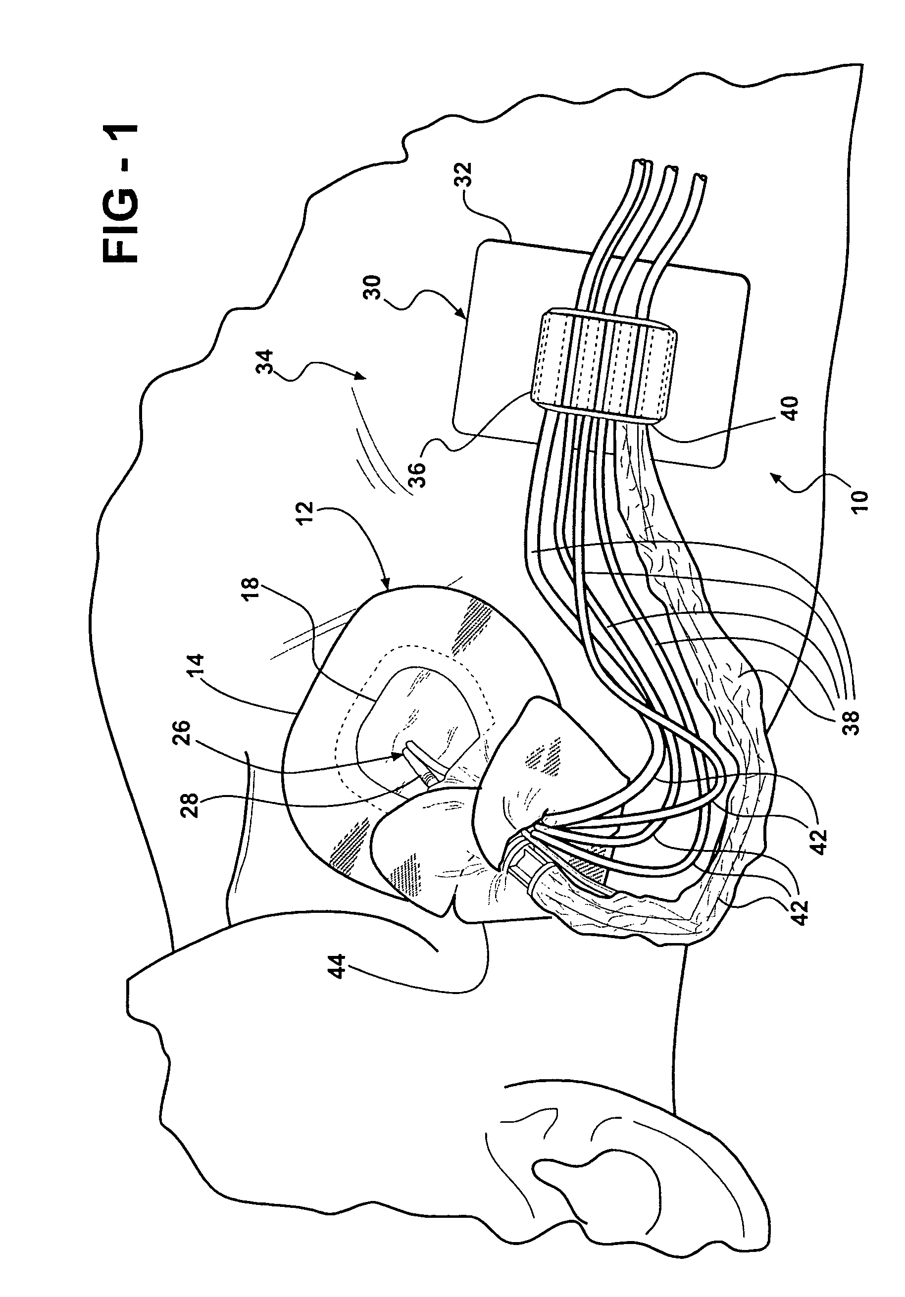 Jugular and subclavian access site dressing, anchoring system and method