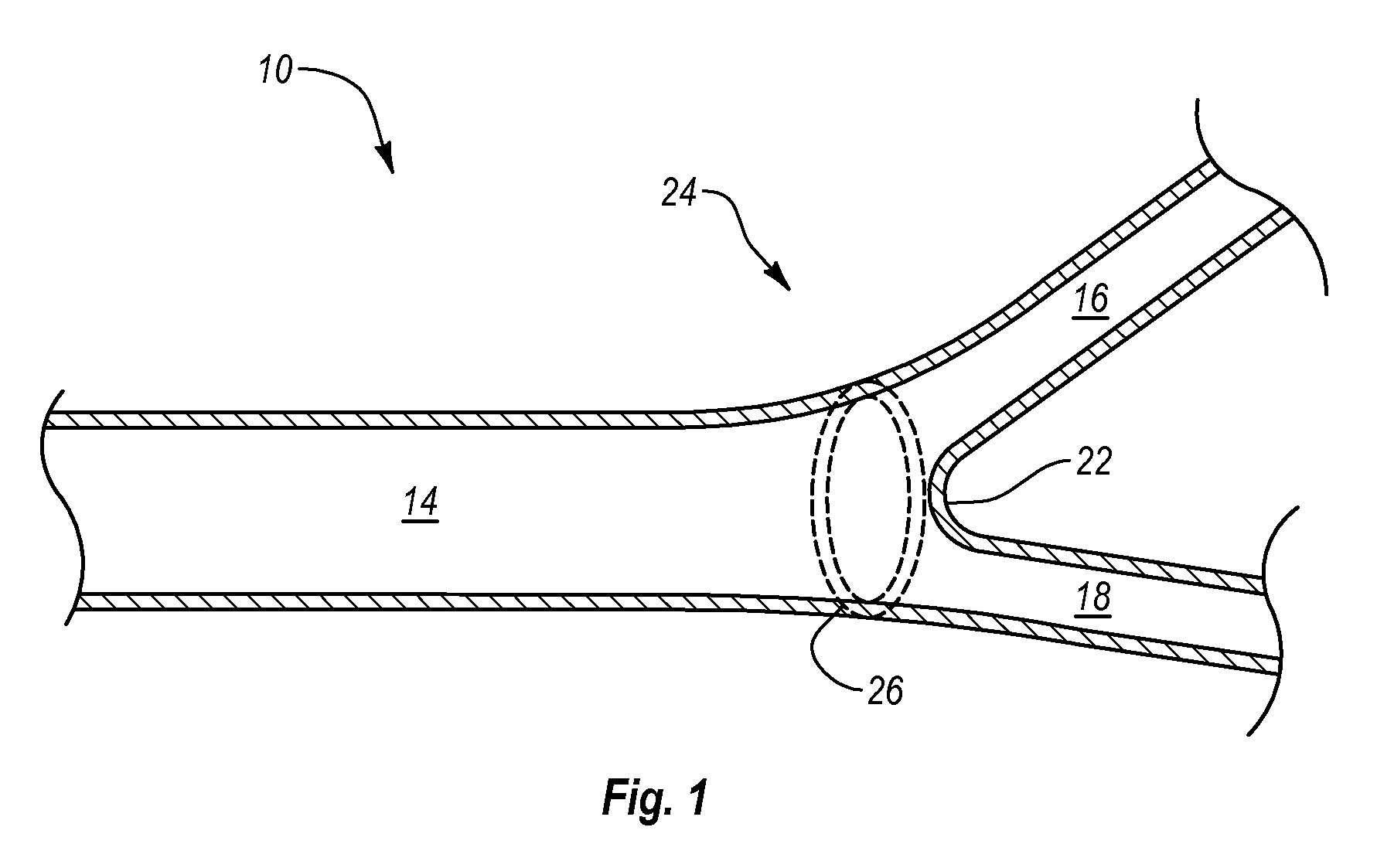 Expandable endoprostheses, systems, and methods for treating a bifurcated lumen