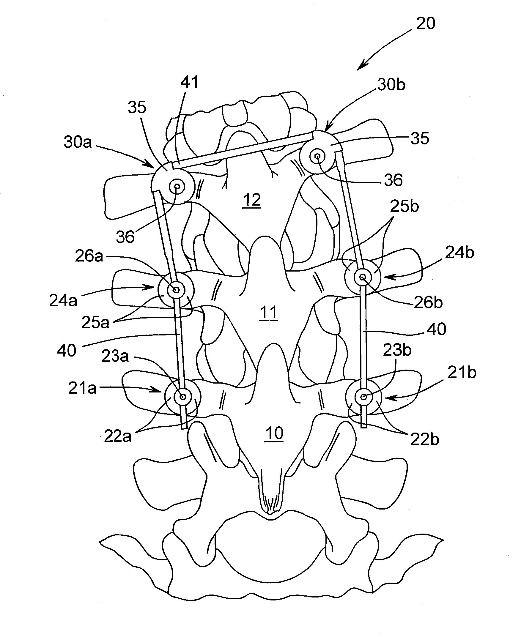 Unidirectional rotatory pedicle screw and spinal deformity correction device for correction of spinal deformity in growing children