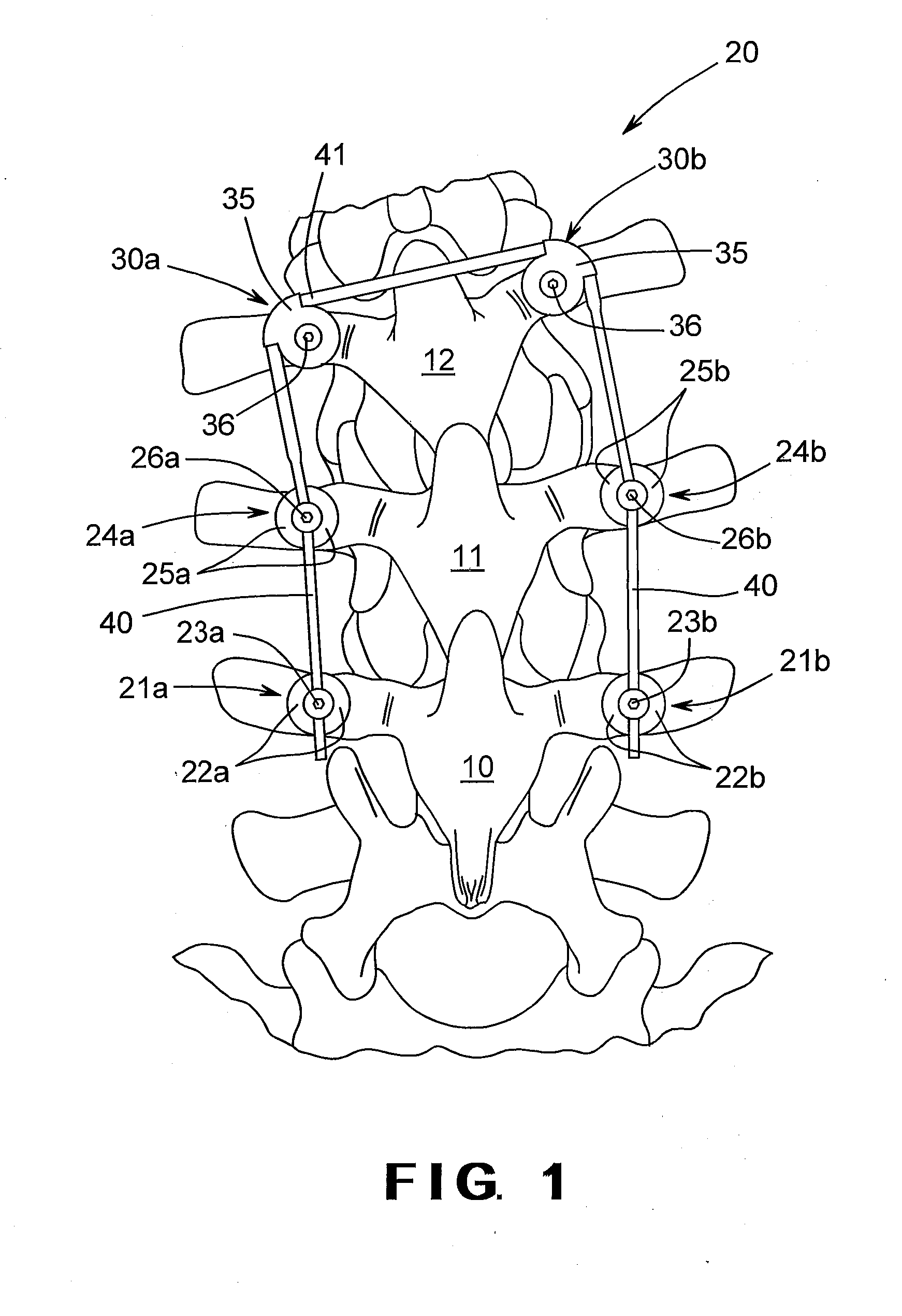 Unidirectional rotatory pedicle screw and spinal deformity correction device for correction of spinal deformity in growing children