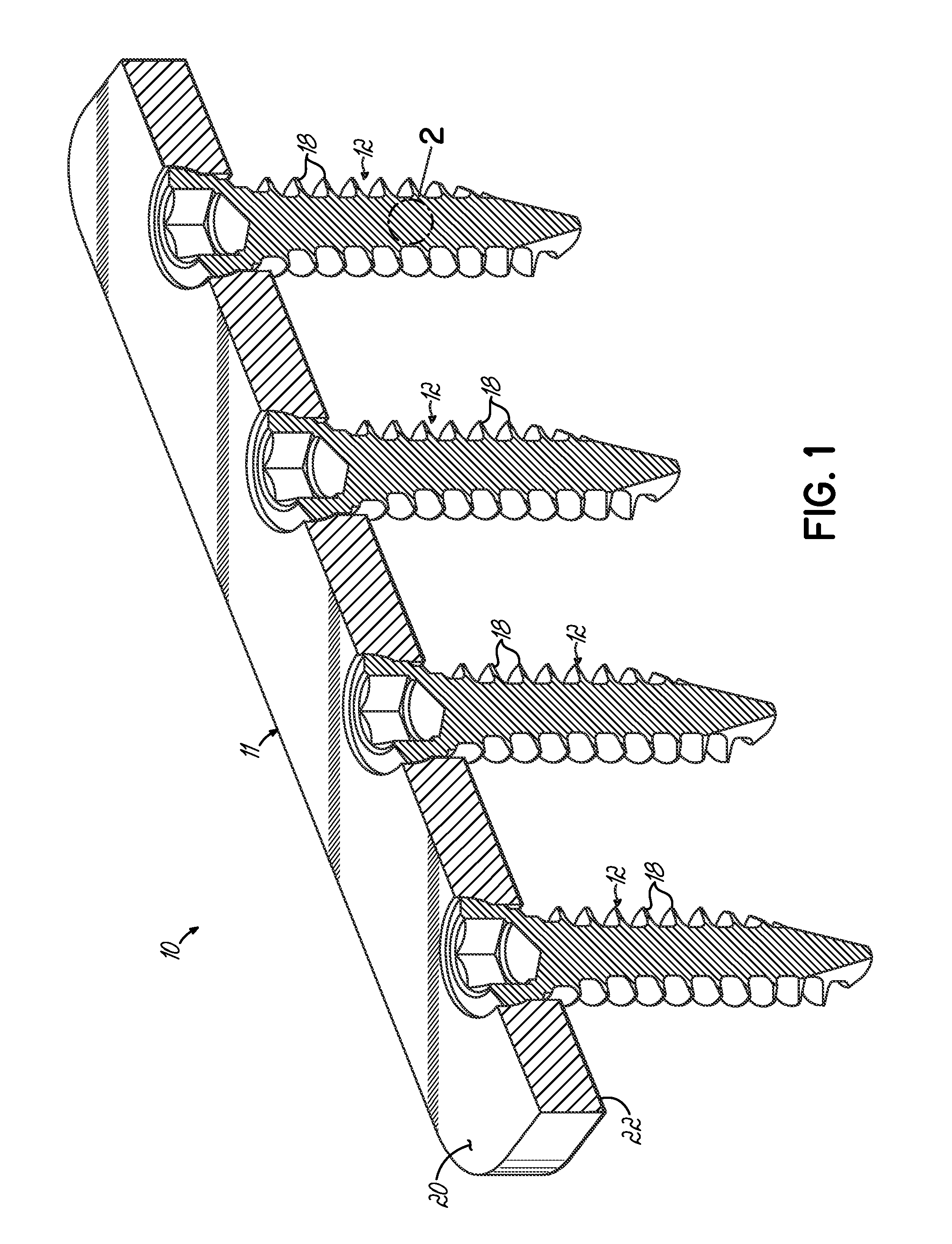 Medical implant formed from porous metal and method