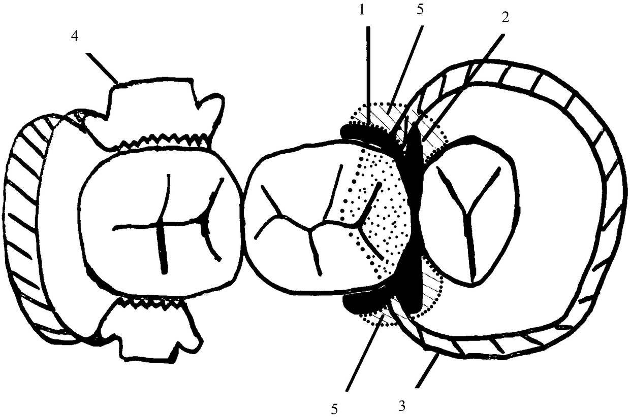 Individualized proximal surface forming system, preparation method thereof and method for auxiliarily filling offending tooth