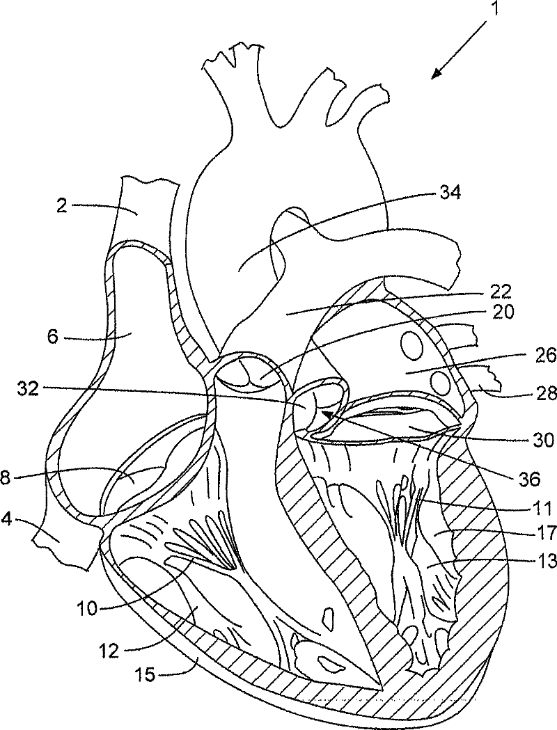 Prosthetic insert for improving heart valve function