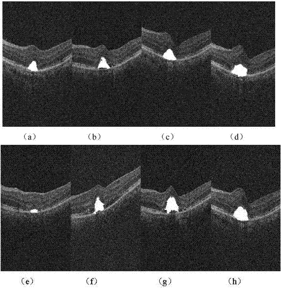 Partitioning algorithm for choroidal neovascularization in OCT image