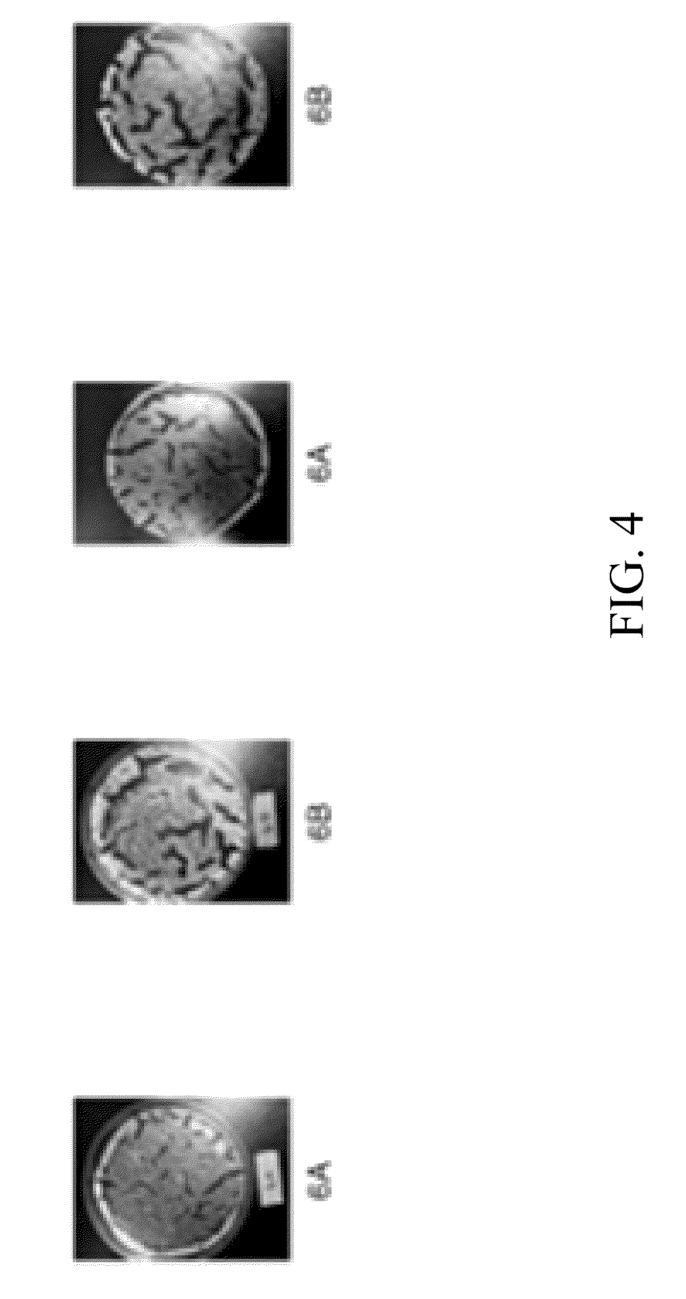 Dissolvable Strip for Treatment of Oral Thermal Burns