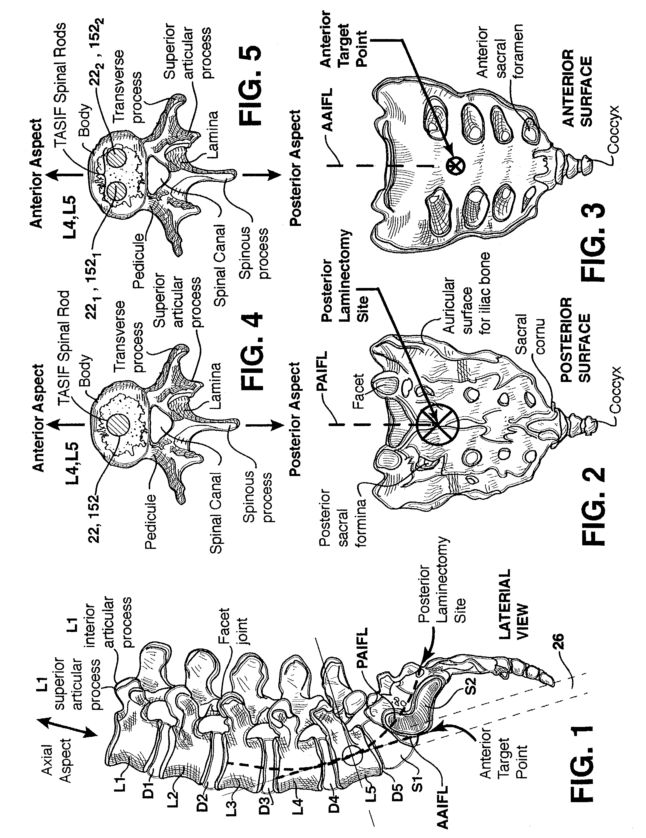 Method and apparatus for providing posterior or anterior trans-sacral access to spinal vertebrae