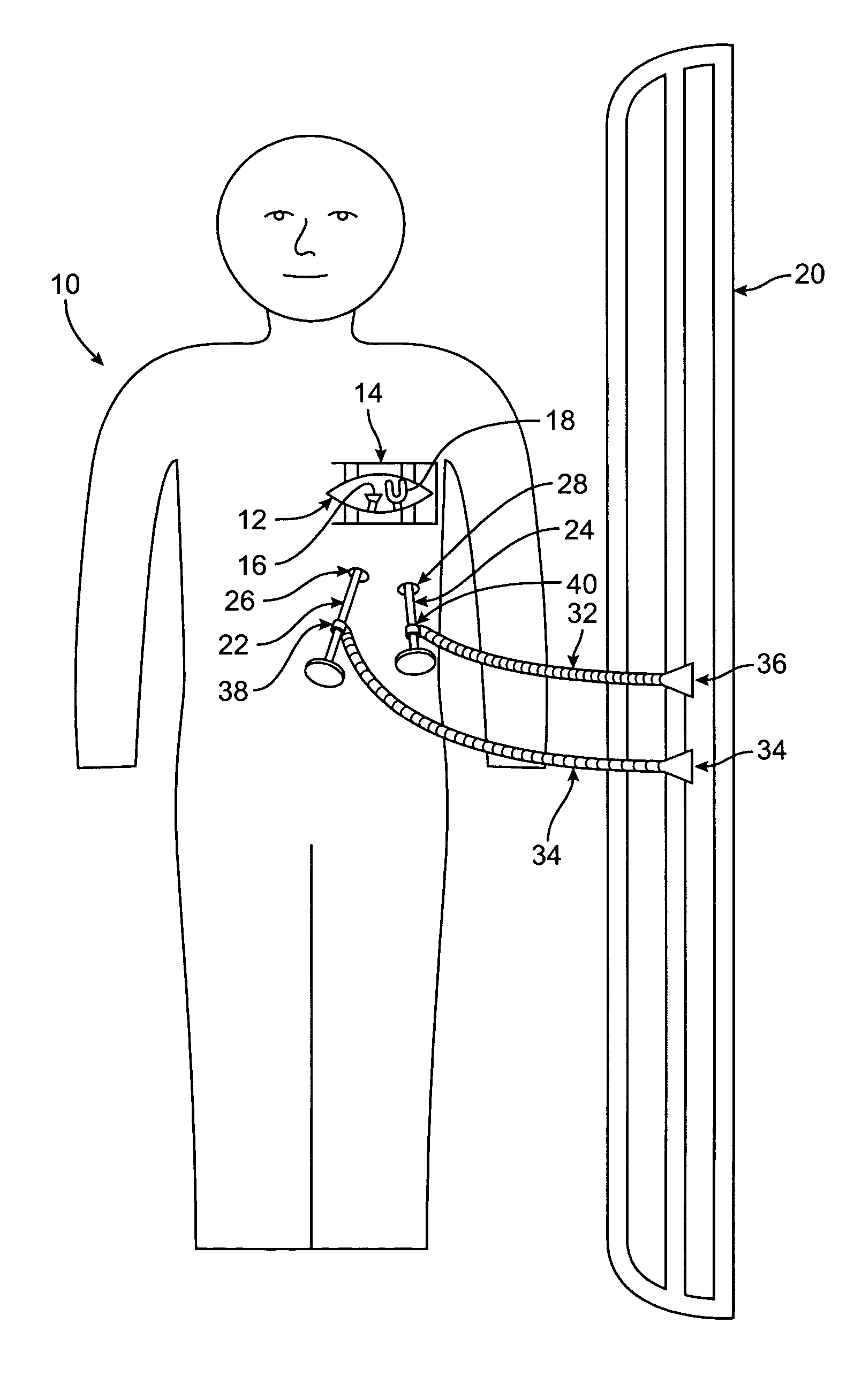 Methods and devices for cardiac surgery
