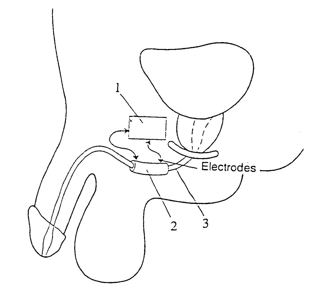 Method and apparatus for treating incontinence