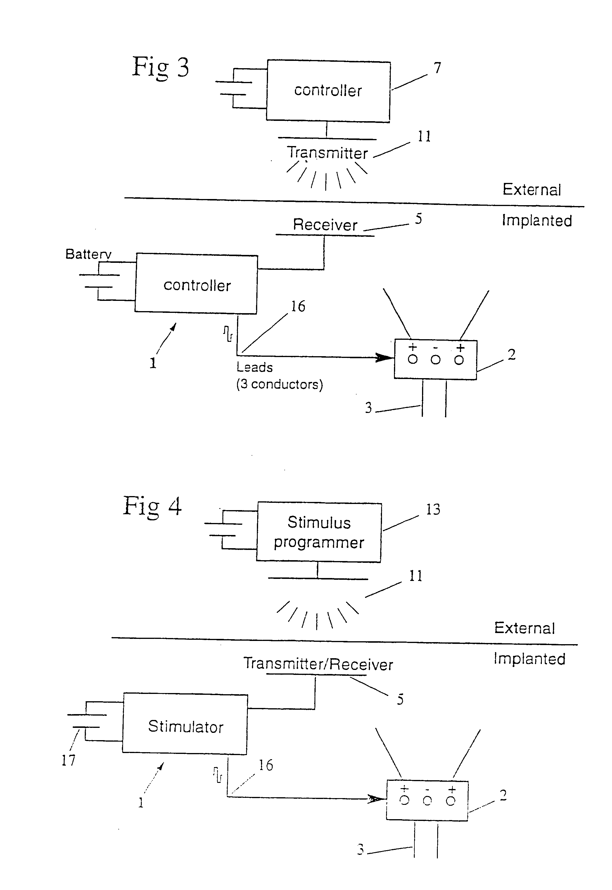 Method and apparatus for treating incontinence