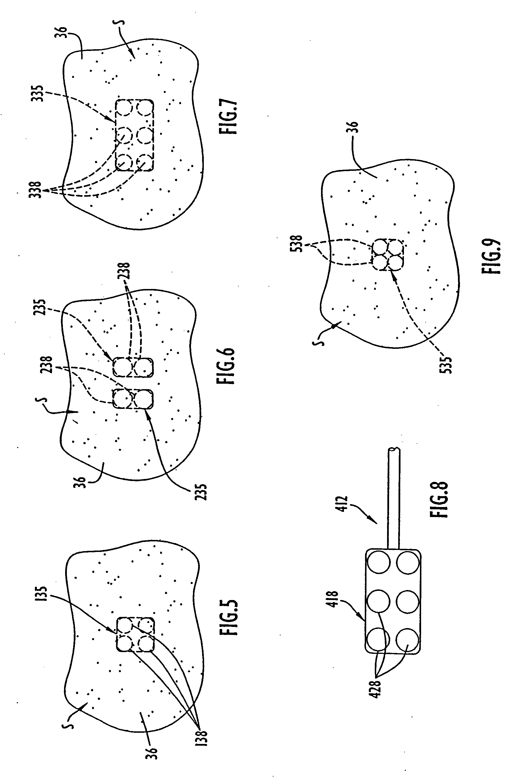 Methods of using high intensity focused ultrasound to form an ablated tissue area