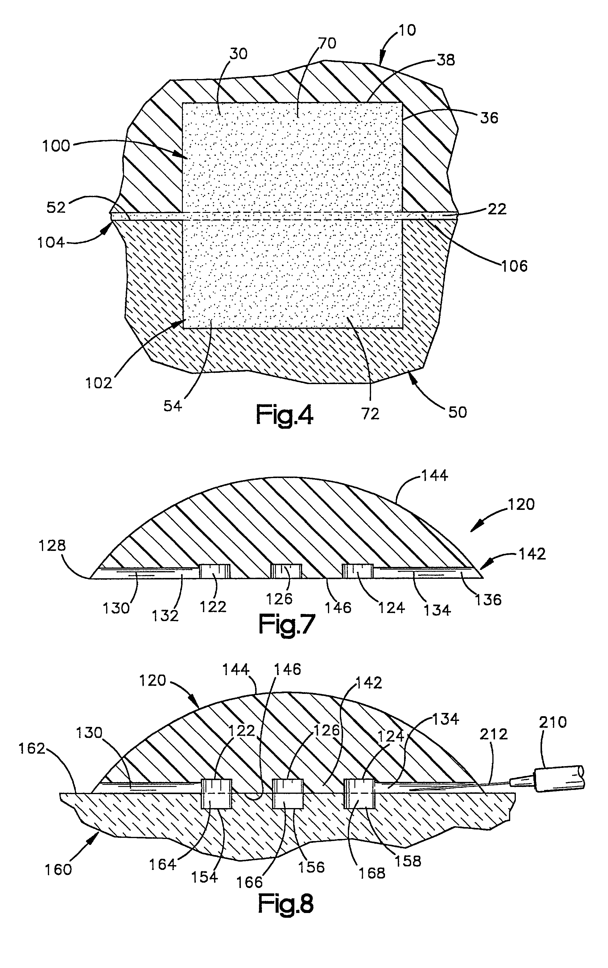 Bone implant and method of securing