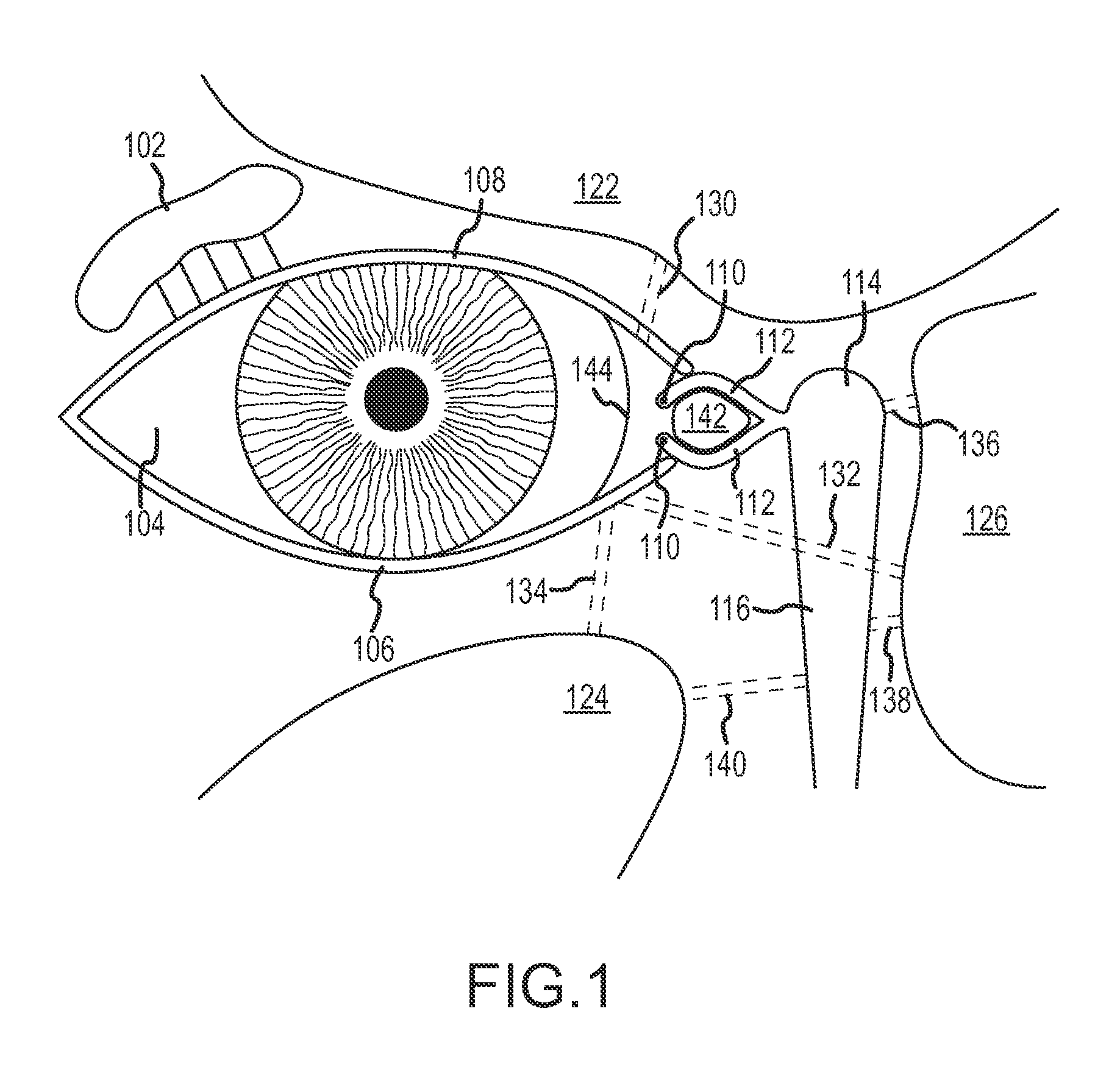 Paranasal sinus access implant devices and related tools, methods and kits