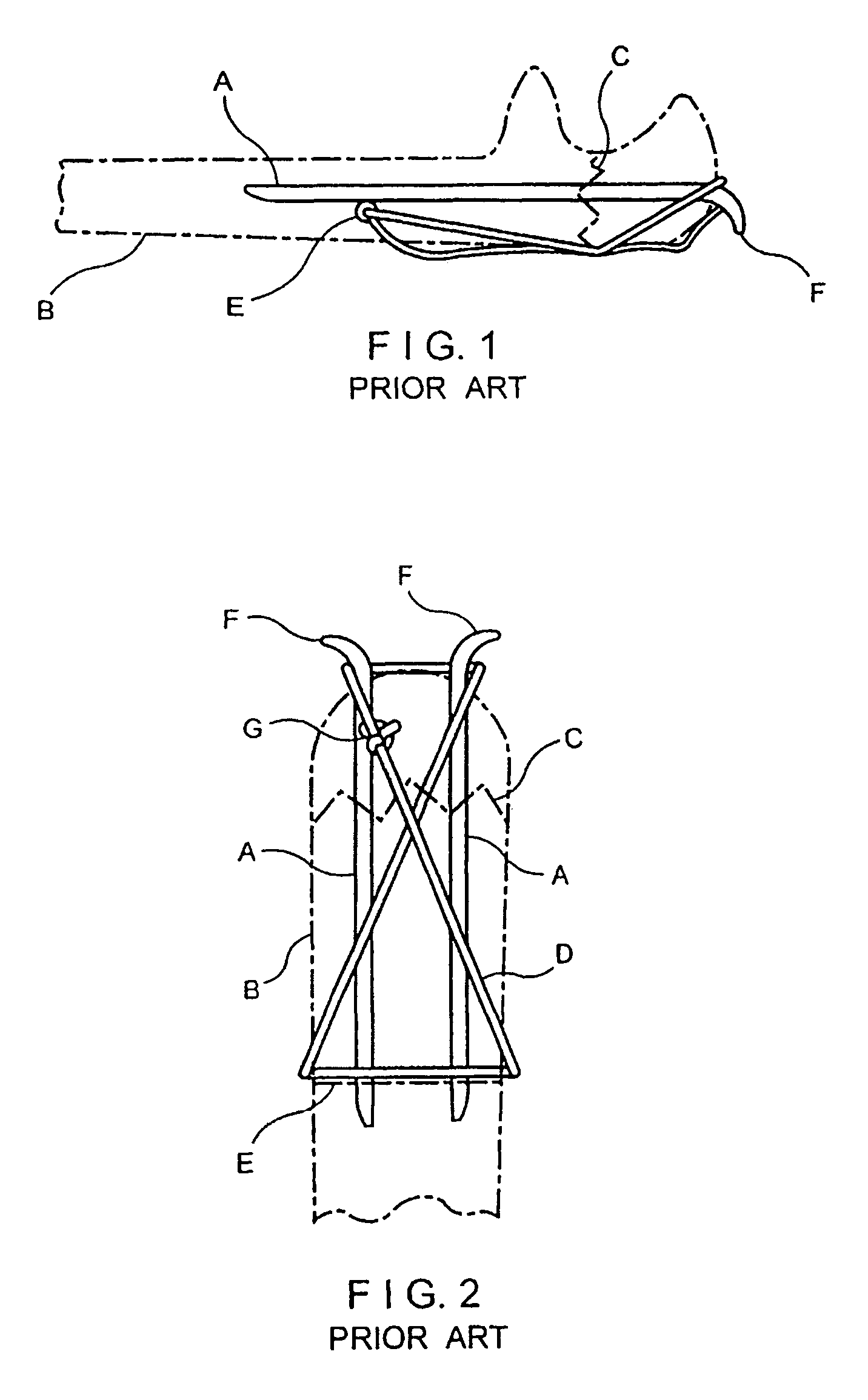 Implant device for applying compression across a fracture site
