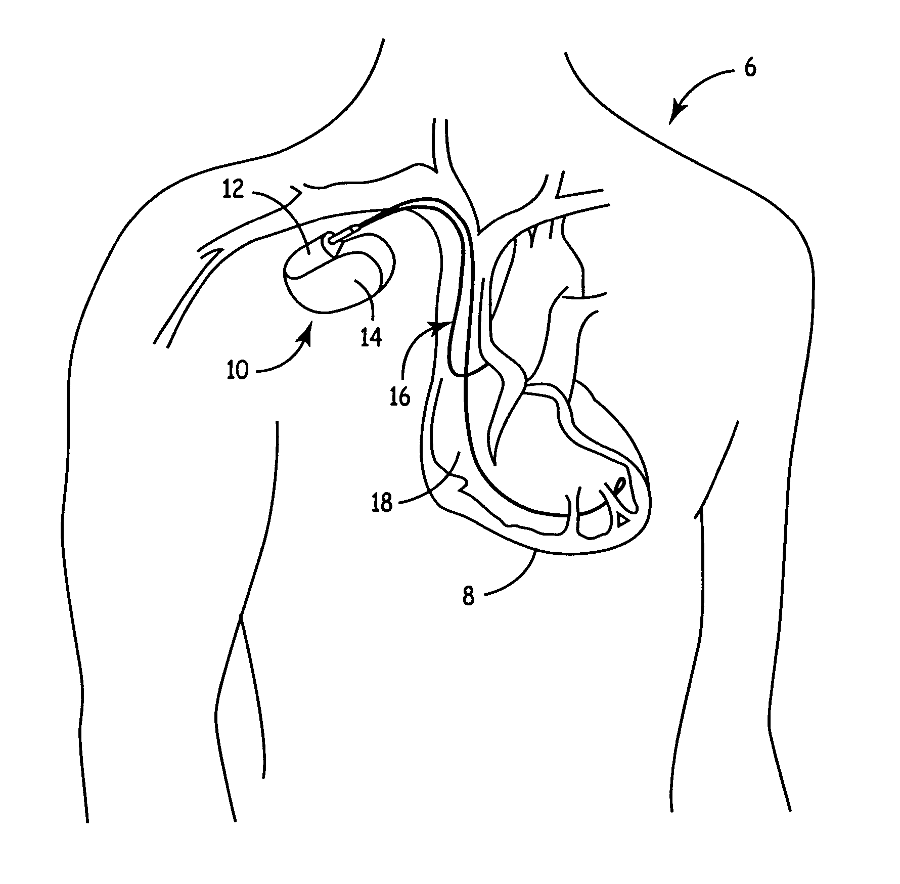 System and method for determining an effectiveness of a ventricular pacing protocol for an implantable medical device