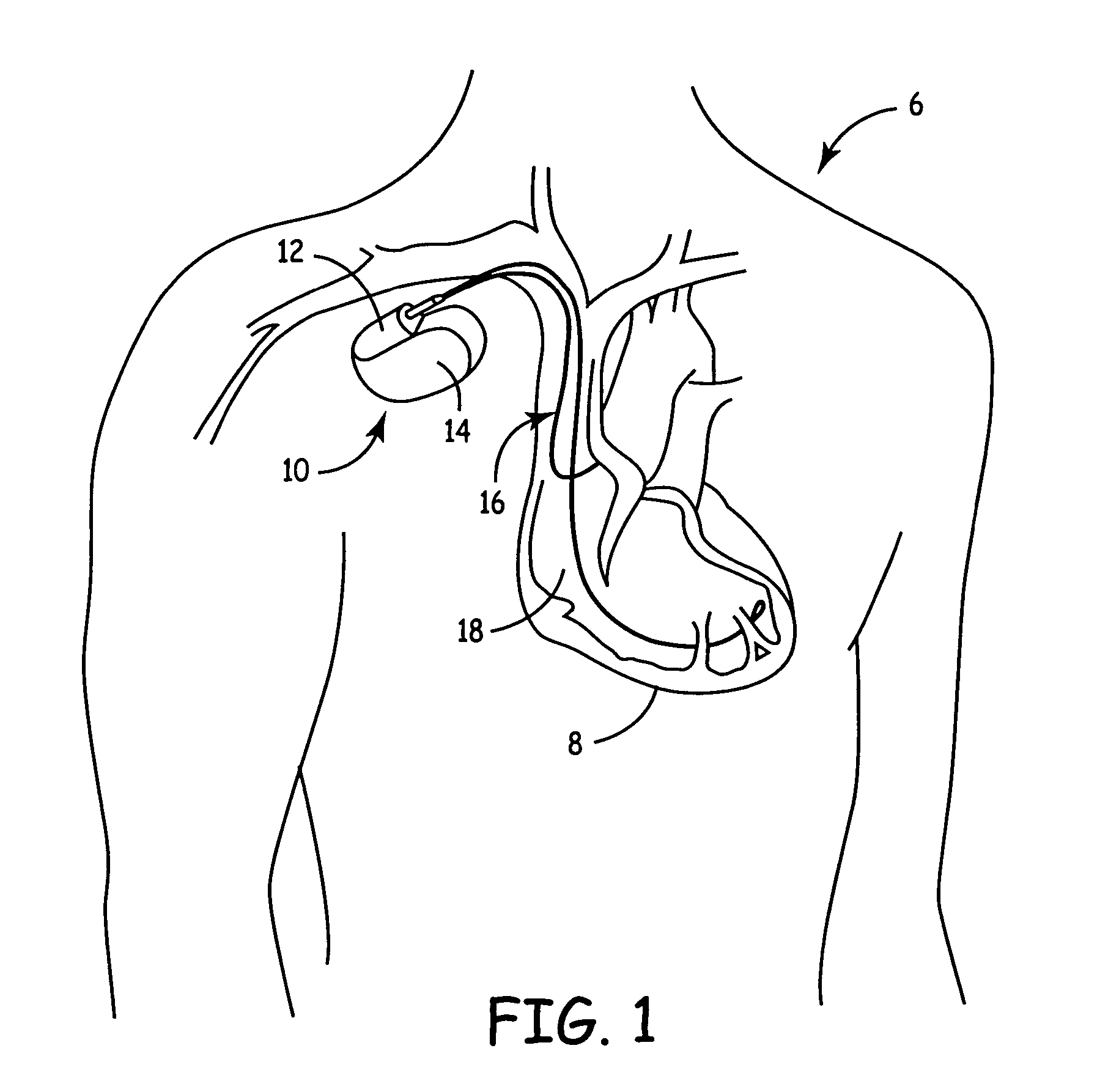 System and method for determining an effectiveness of a ventricular pacing protocol for an implantable medical device