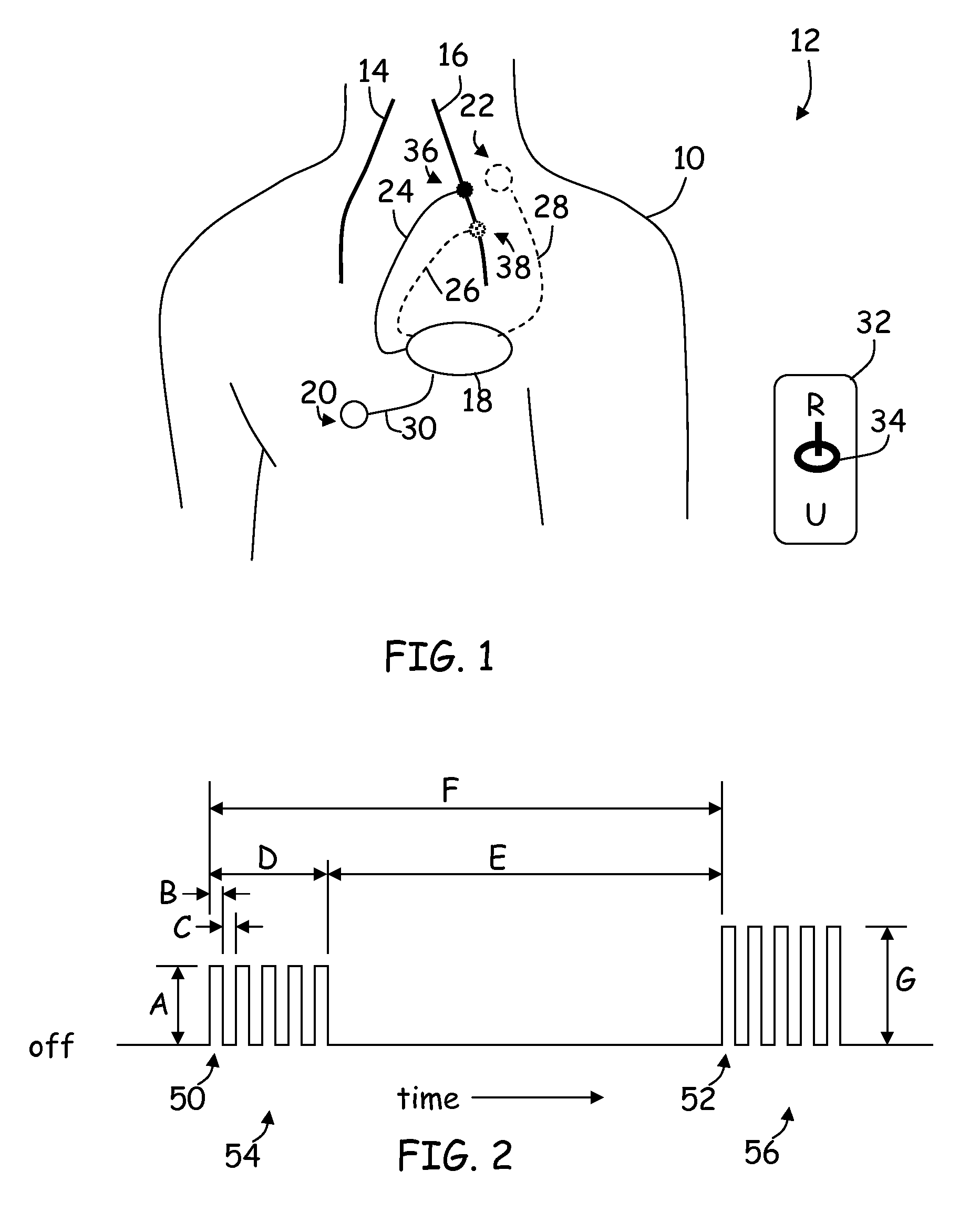 Method and apparatus to enhance therapy during stimulation of vagus nerve