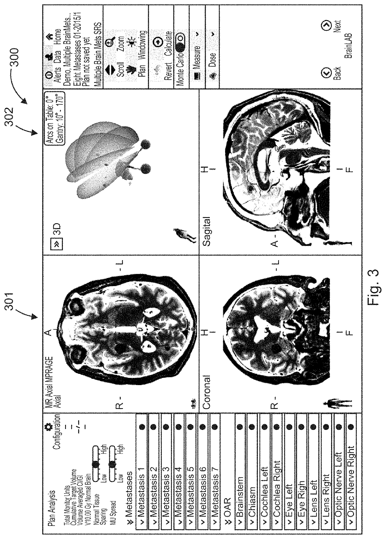 Computer-implemented medical method for radiation treatment (RT) planning for treating multiple brain metastases of a patient