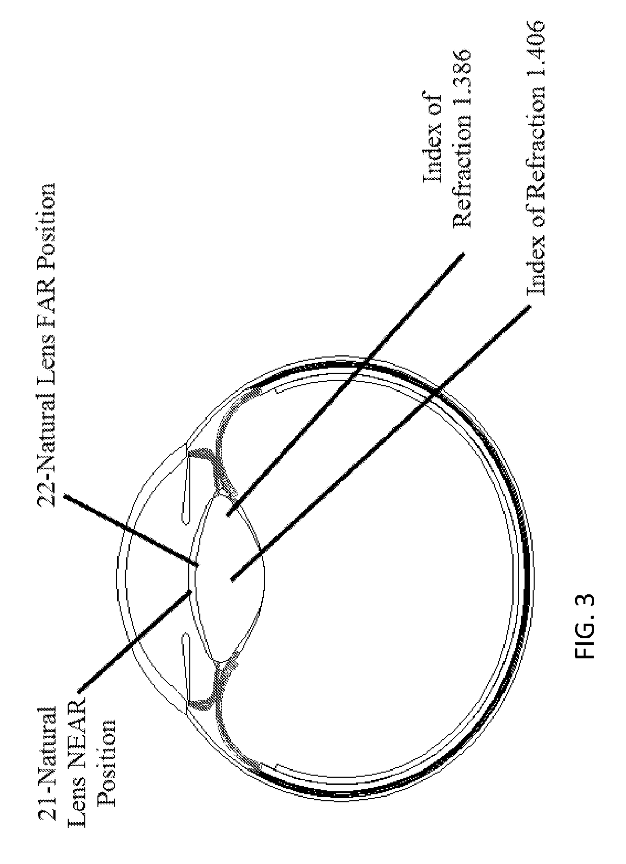 Accommodative intraocular lens that ejects post capsular opacification and self-centers