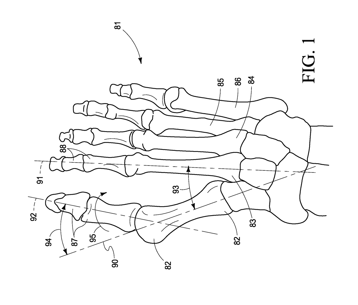 Combined intramedullary-extramedullary bone stabilization and alignment system